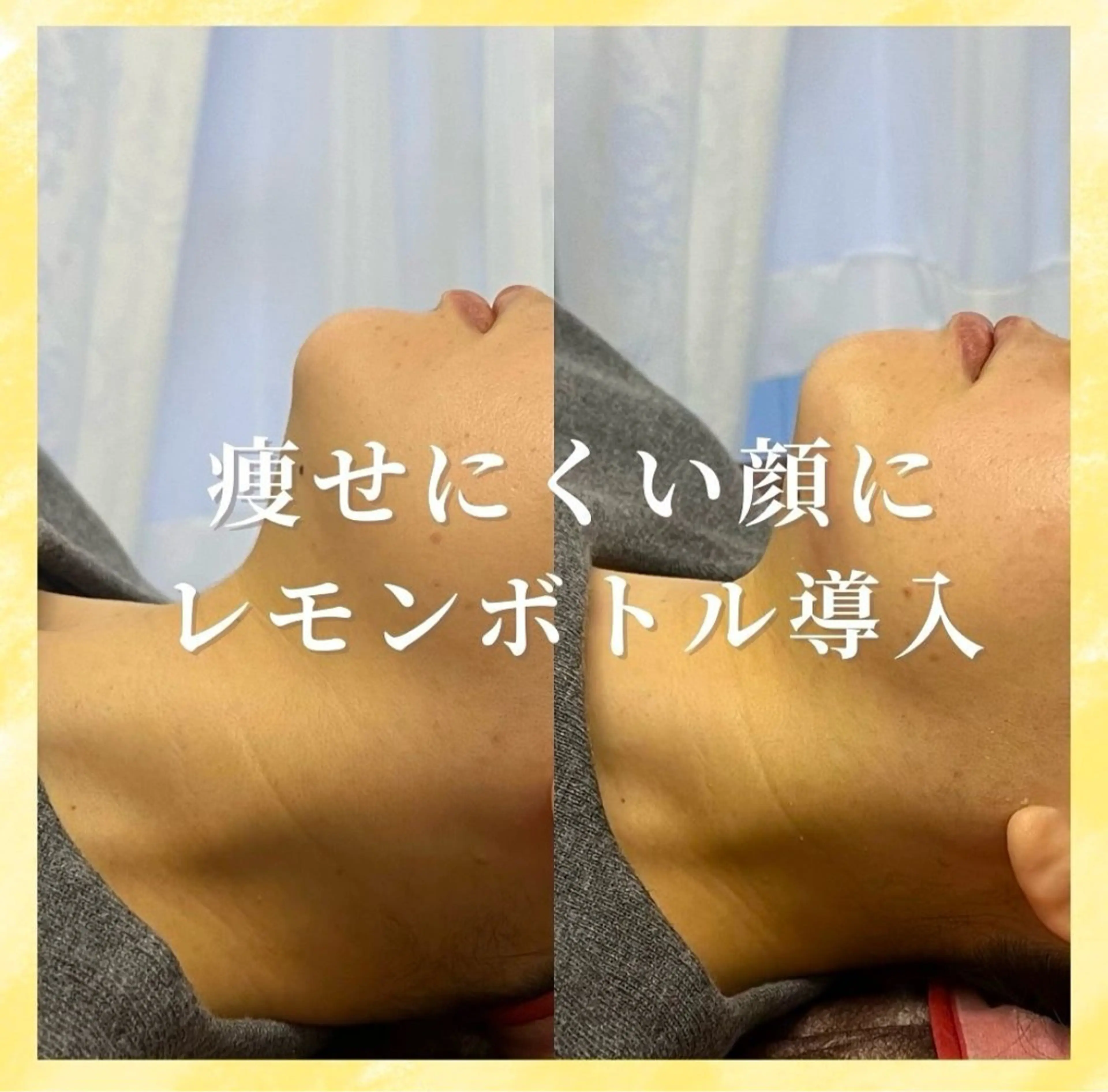 韓国で話題🇰🇷リバウンドなし⭕️脂肪細胞集中アプローチ【レモンボトル🍋2cc】の写真