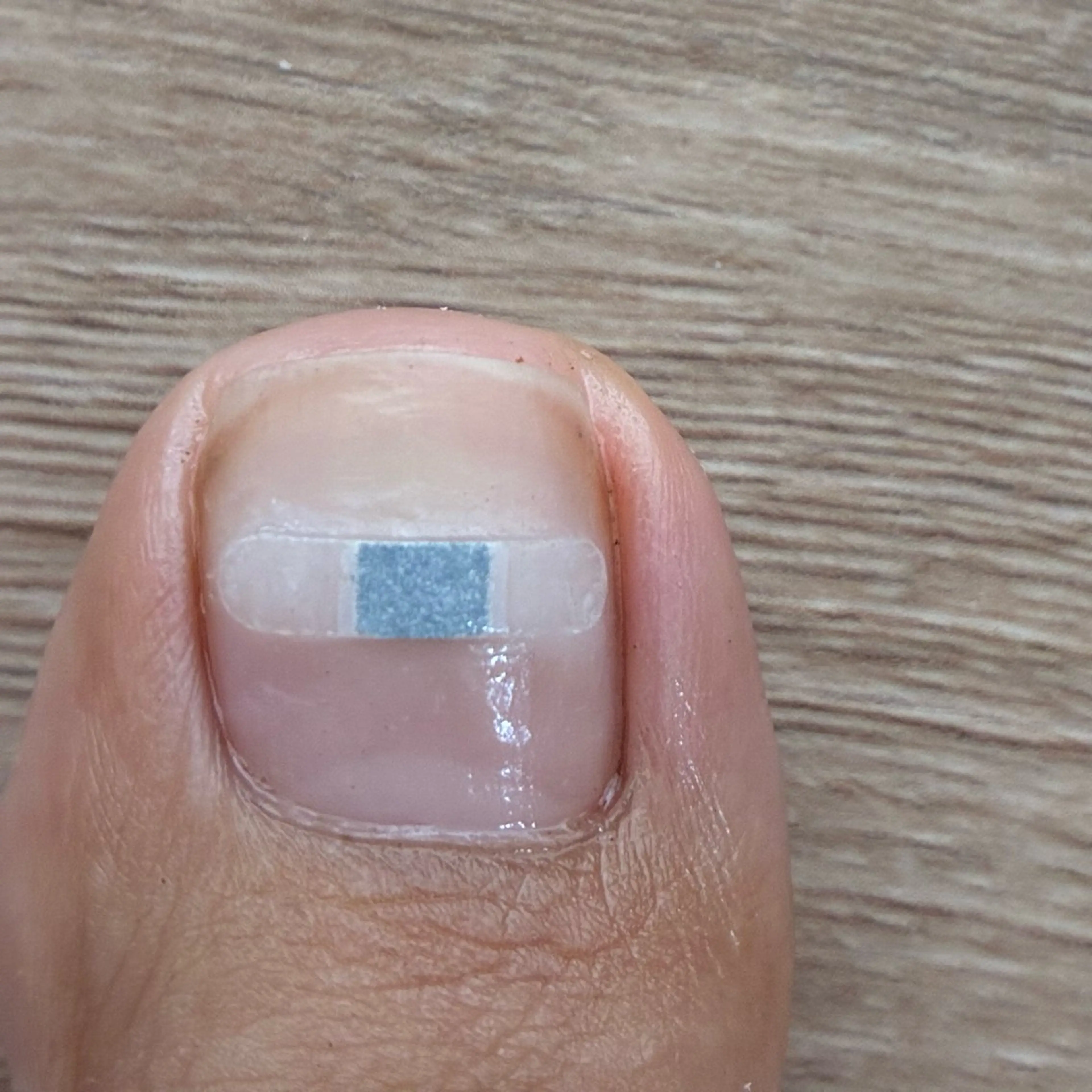 \モニター10名様限定/【foot】巻き爪改善ケアの写真