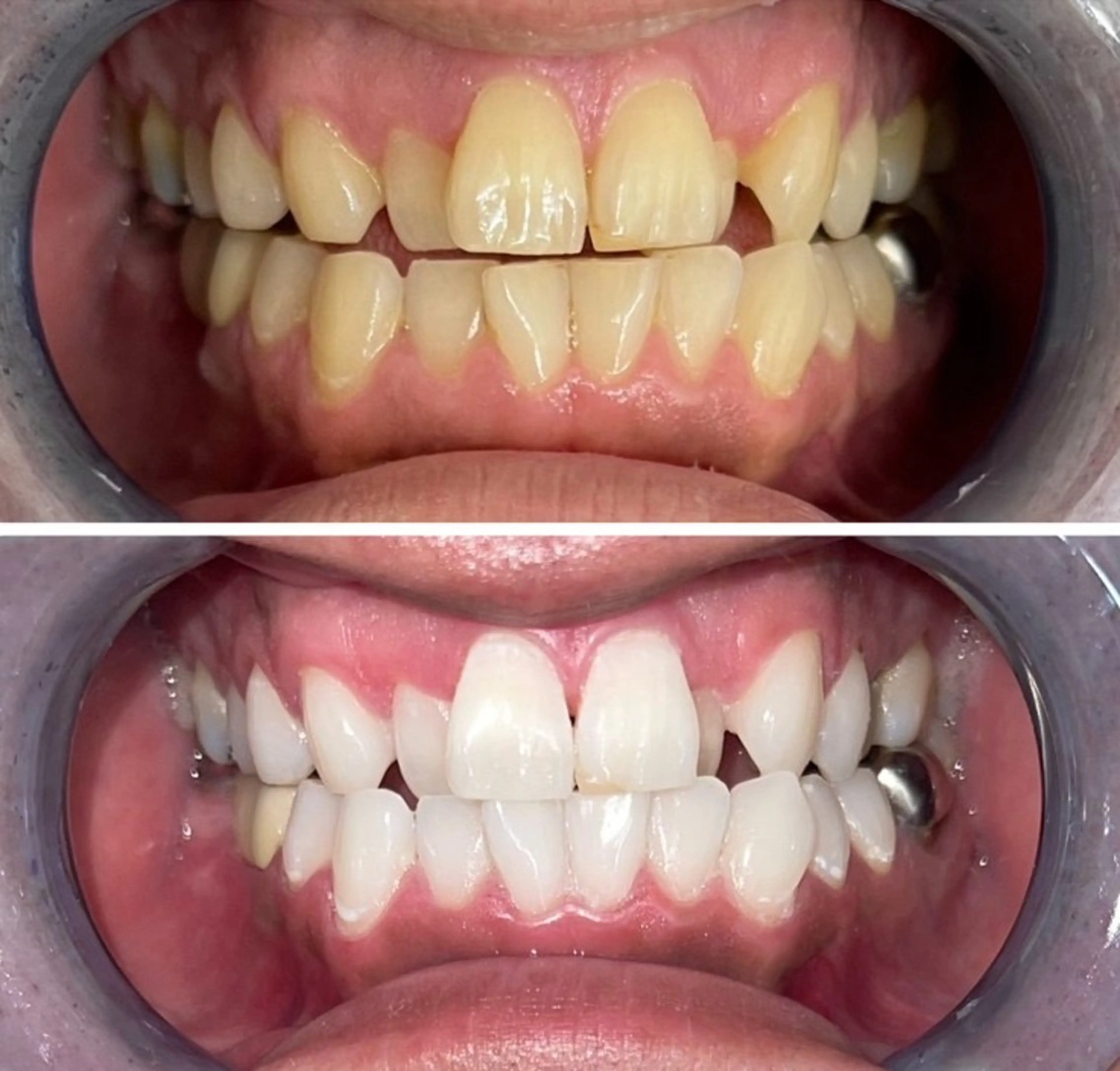 今だけ限定！歯科ホワイトニング20分2980円の写真