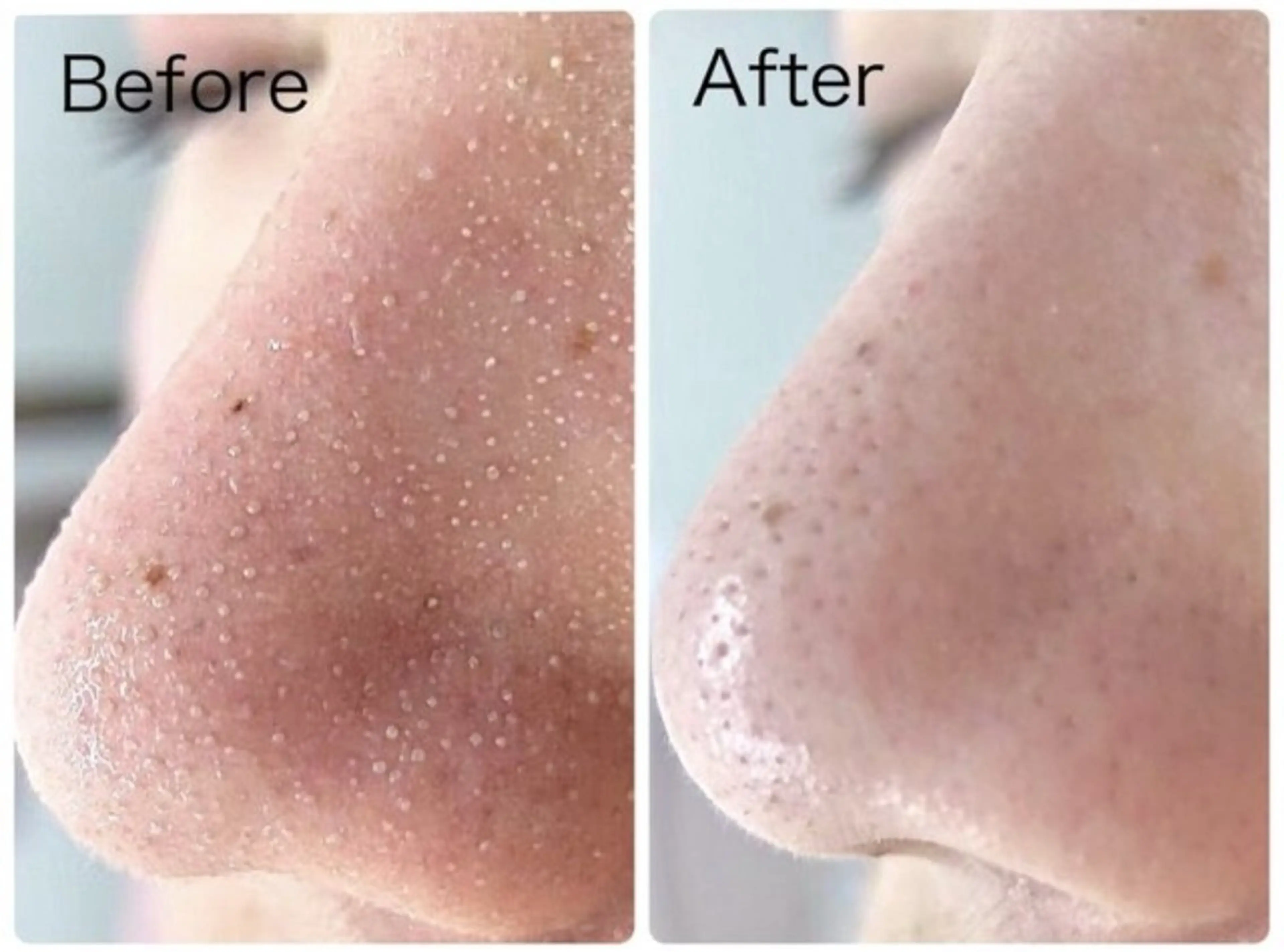 毛穴悩みに◎【3D毛穴洗浄＋高保湿パック付】の写真