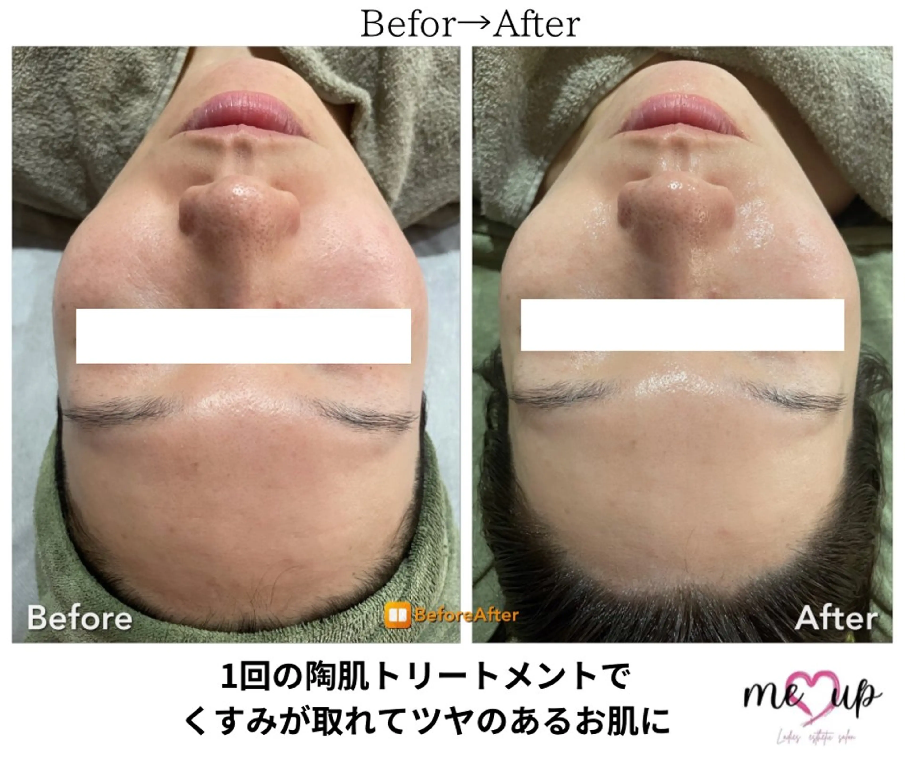 エステ Meupニキビ専門店 背中/ハーブ/肌管理のその他イメージ