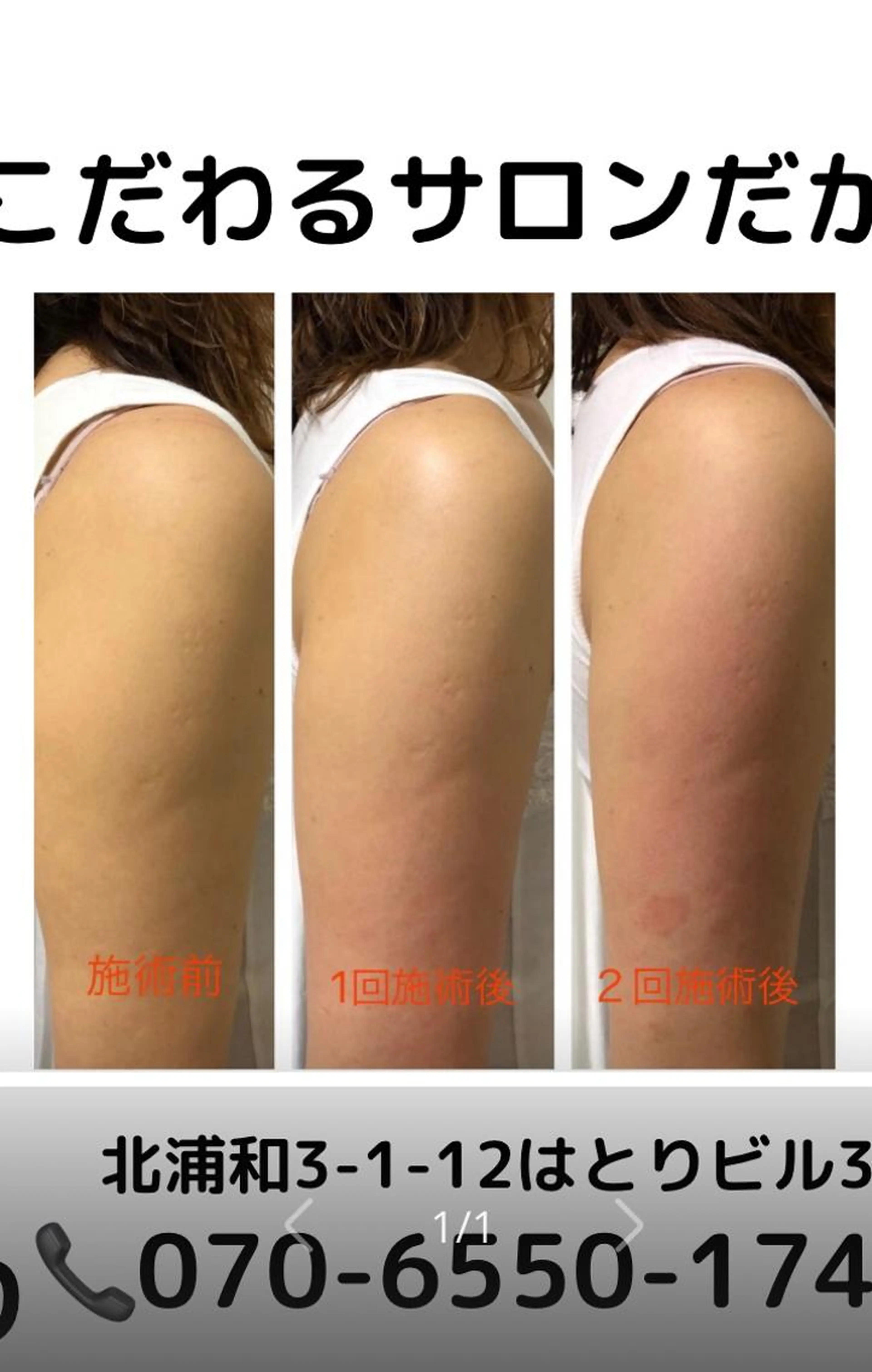 🌻ミニモ限定🌻二の腕痩せコース60分の写真