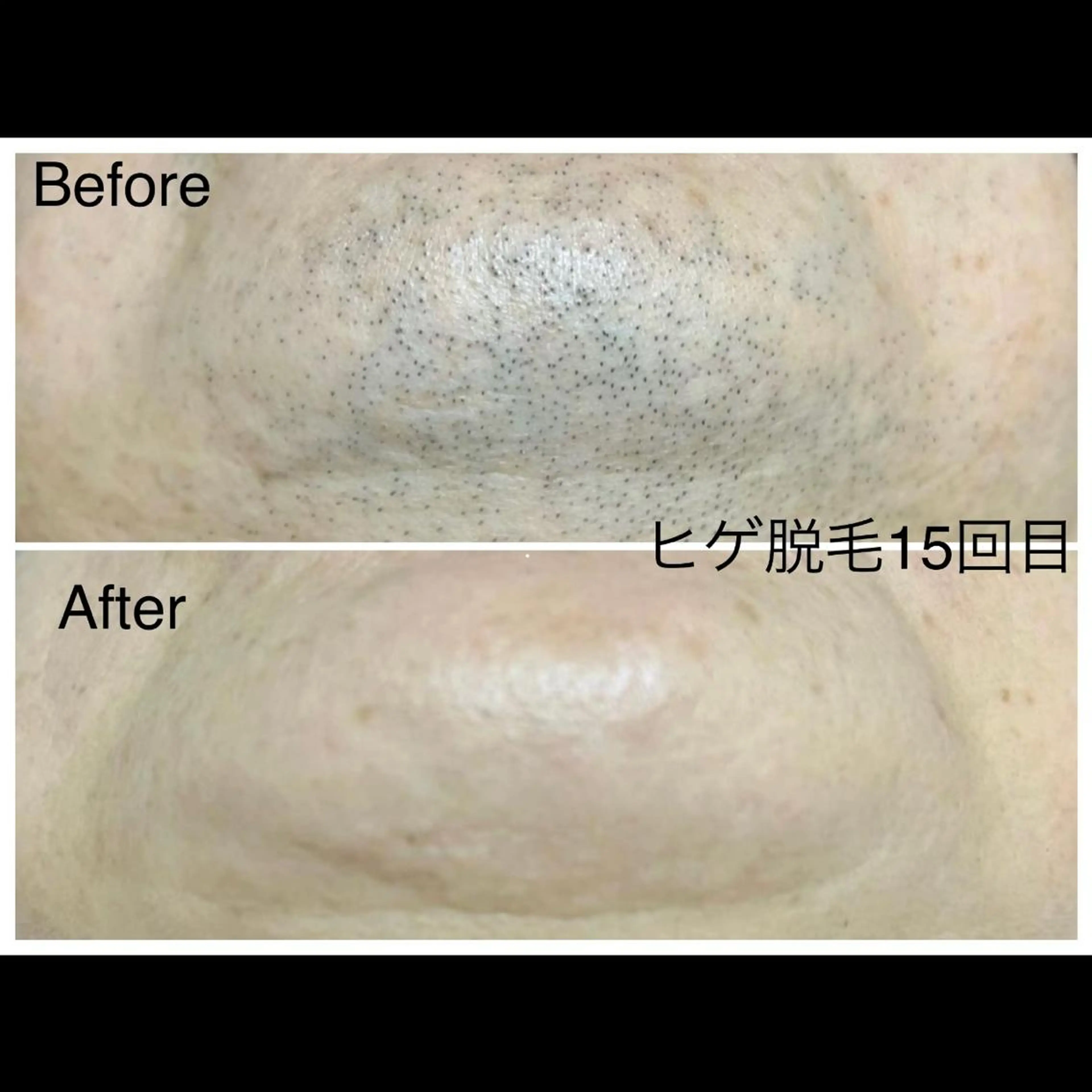 メンズ キッズ 学生（メンズ向け） 医療提携メンズ脱毛 CDFAkasakaのエステ・リラクイメージ