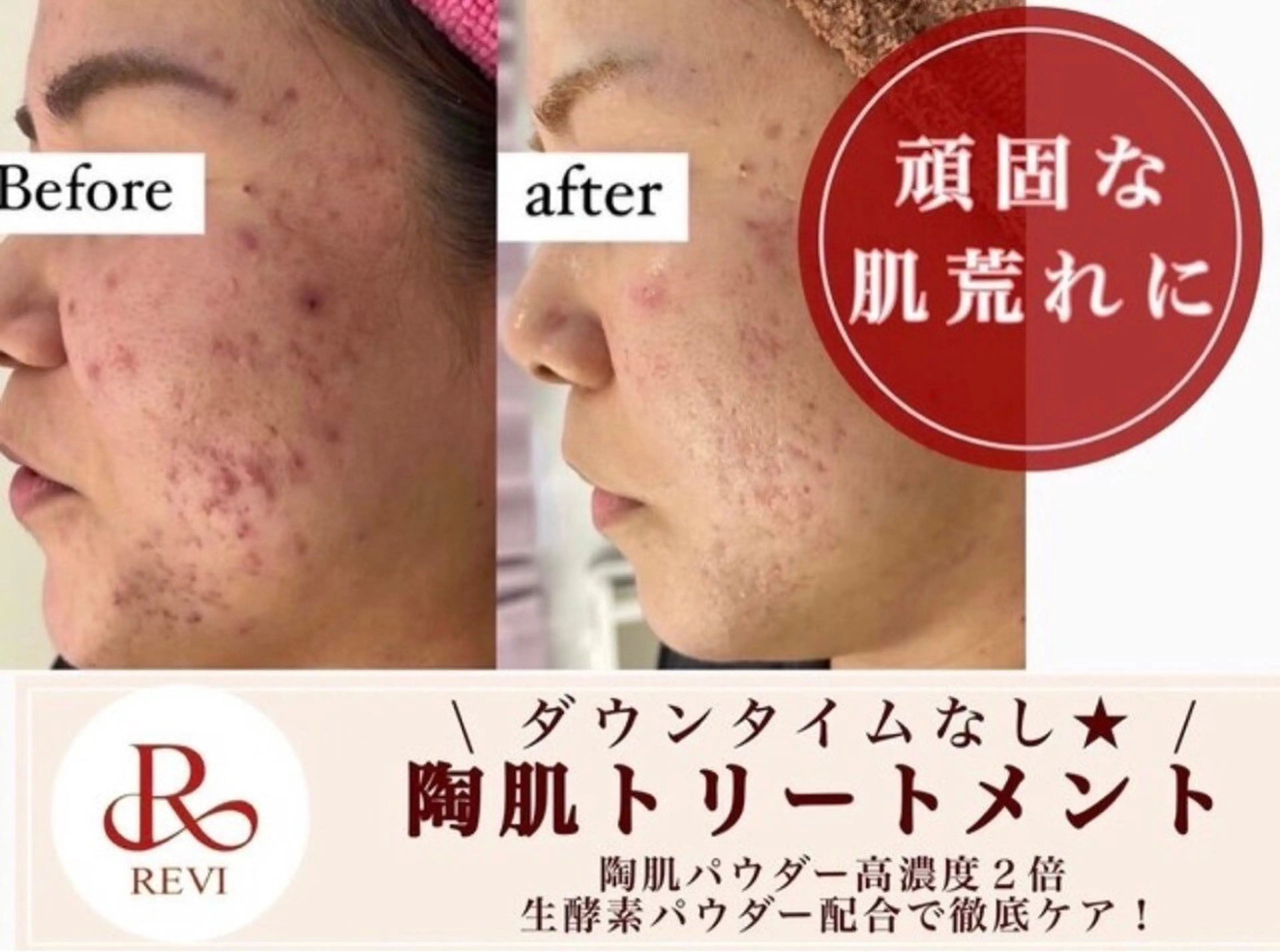 💜頑固な肌荒れに💜REVIハーブピーリング＋生酵素パウダー1g🌹¥14,200の写真