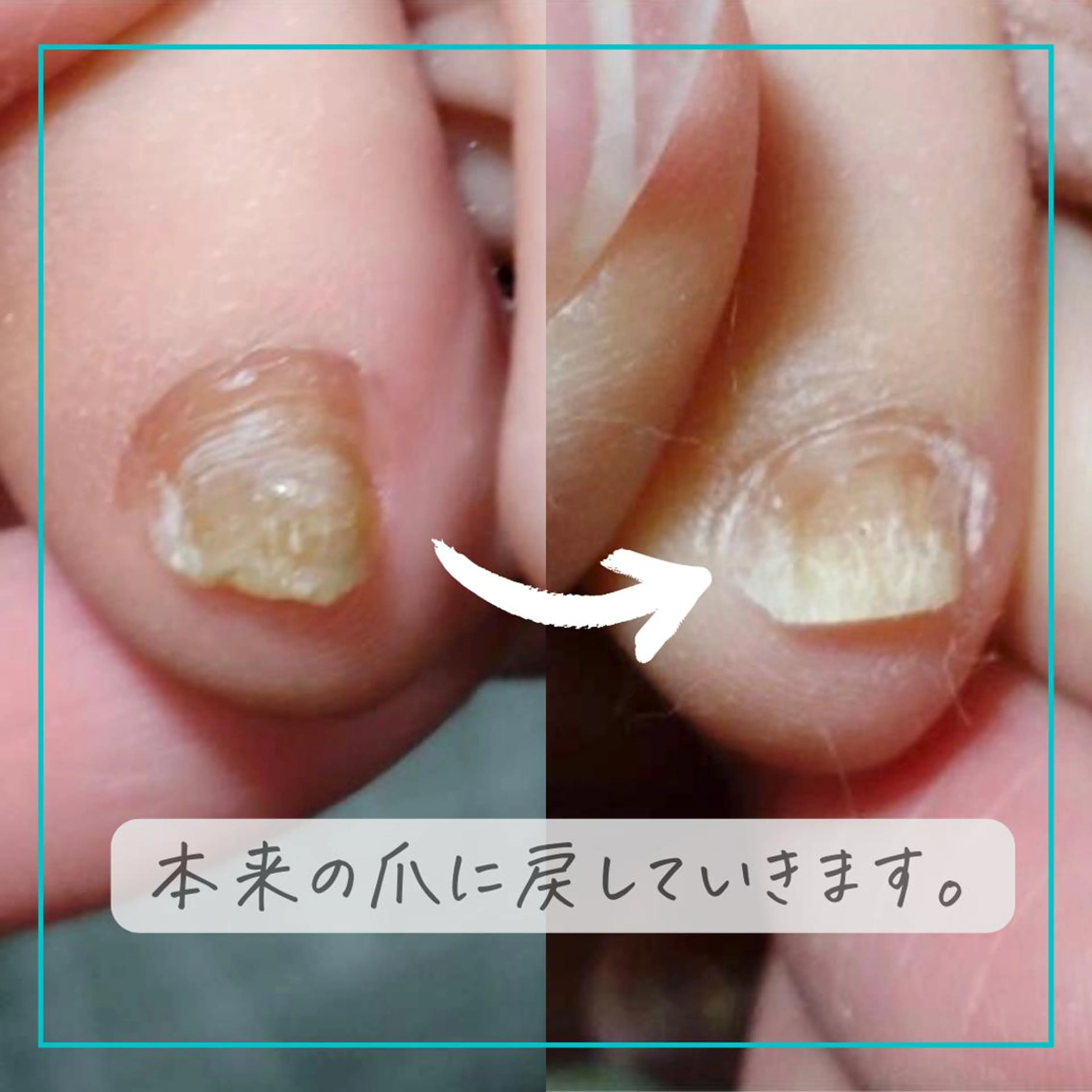 ネイル 深爪・巻き爪 専門サンセリテのネイルデザイン