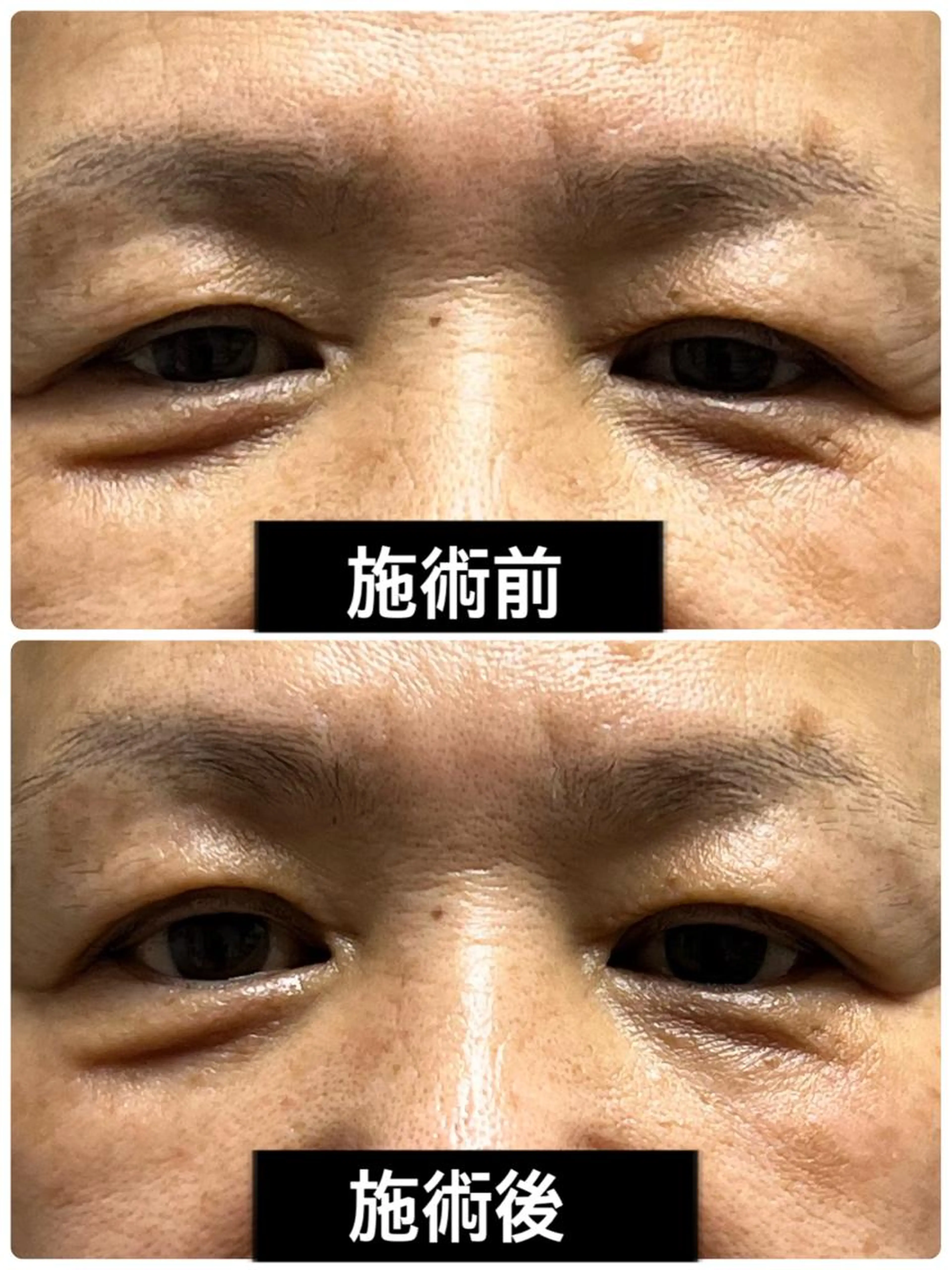 やればやるほど整形超え！プラズマシャワー【リブセラ】フェイシャル　トライアルの写真