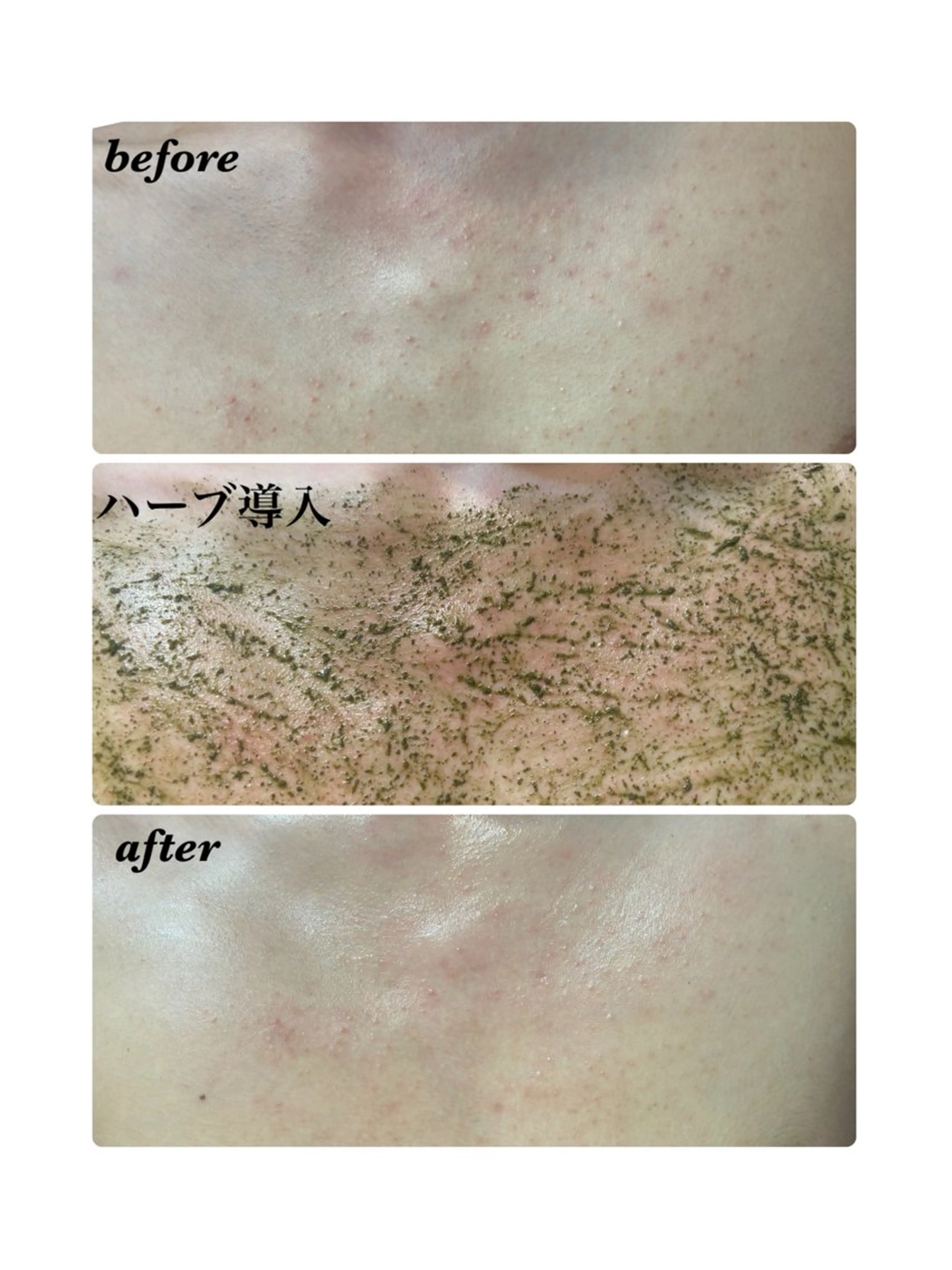 ハーブピーリング/韓国肌管理/フェイシャル/毛穴洗浄/眉毛/顔脱毛【糸脱毛専門】rev所属・ハーブピーリング🌹 毛穴洗浄❤️眉waxのエステ・リラクイメージ