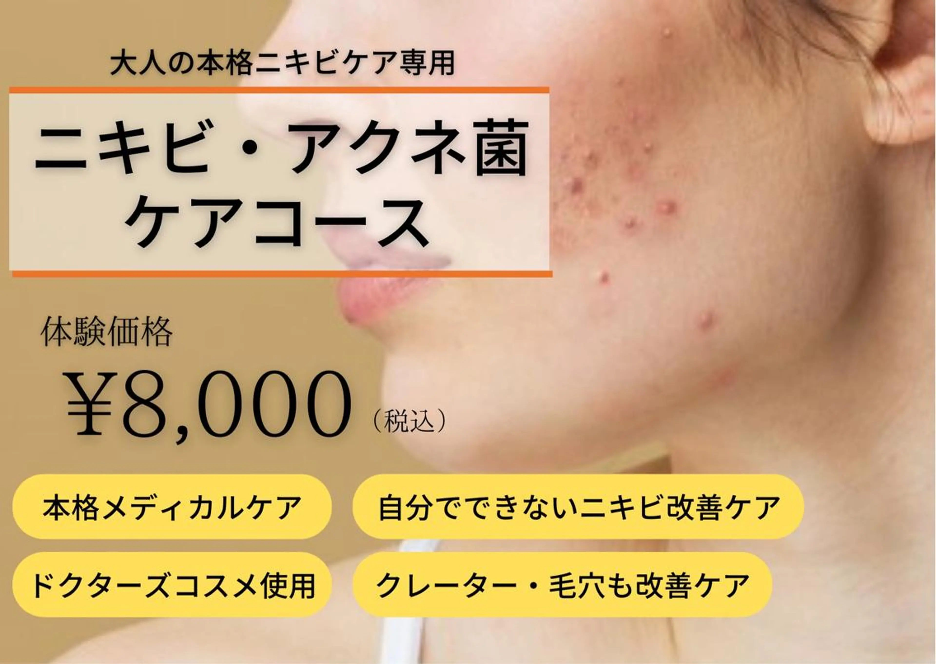 【ニキビケア・アクネ菌コース￥8,000】本格ケアでお悩み根本改善！の写真