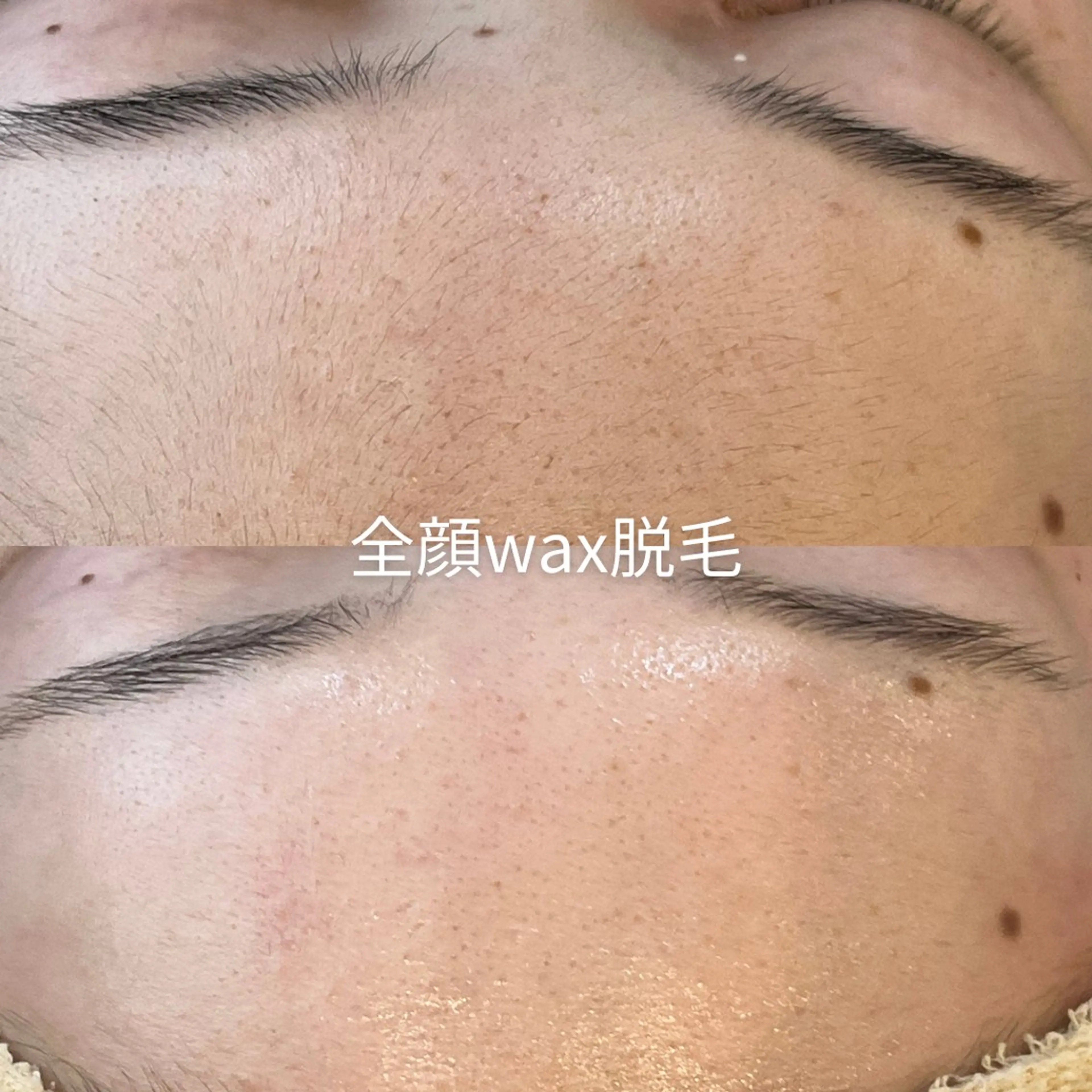 顔ワックス脱毛×保湿・毛穴洗浄パックの写真