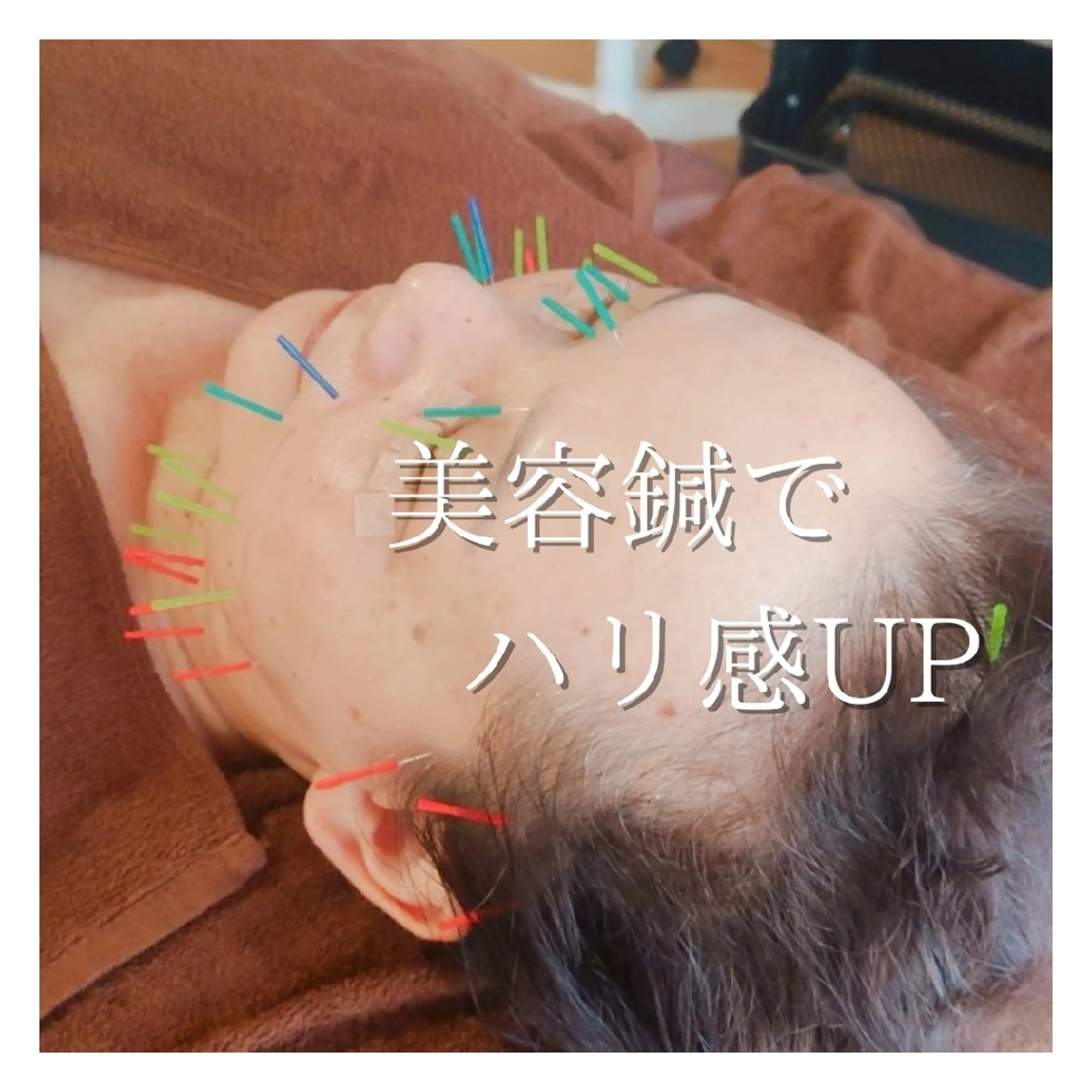 エステ リラク 鍼灸サロンmiyabi所属・美容鍼×エステ 鍼灸 サロンmiyabiのエステ・リラクイメージ