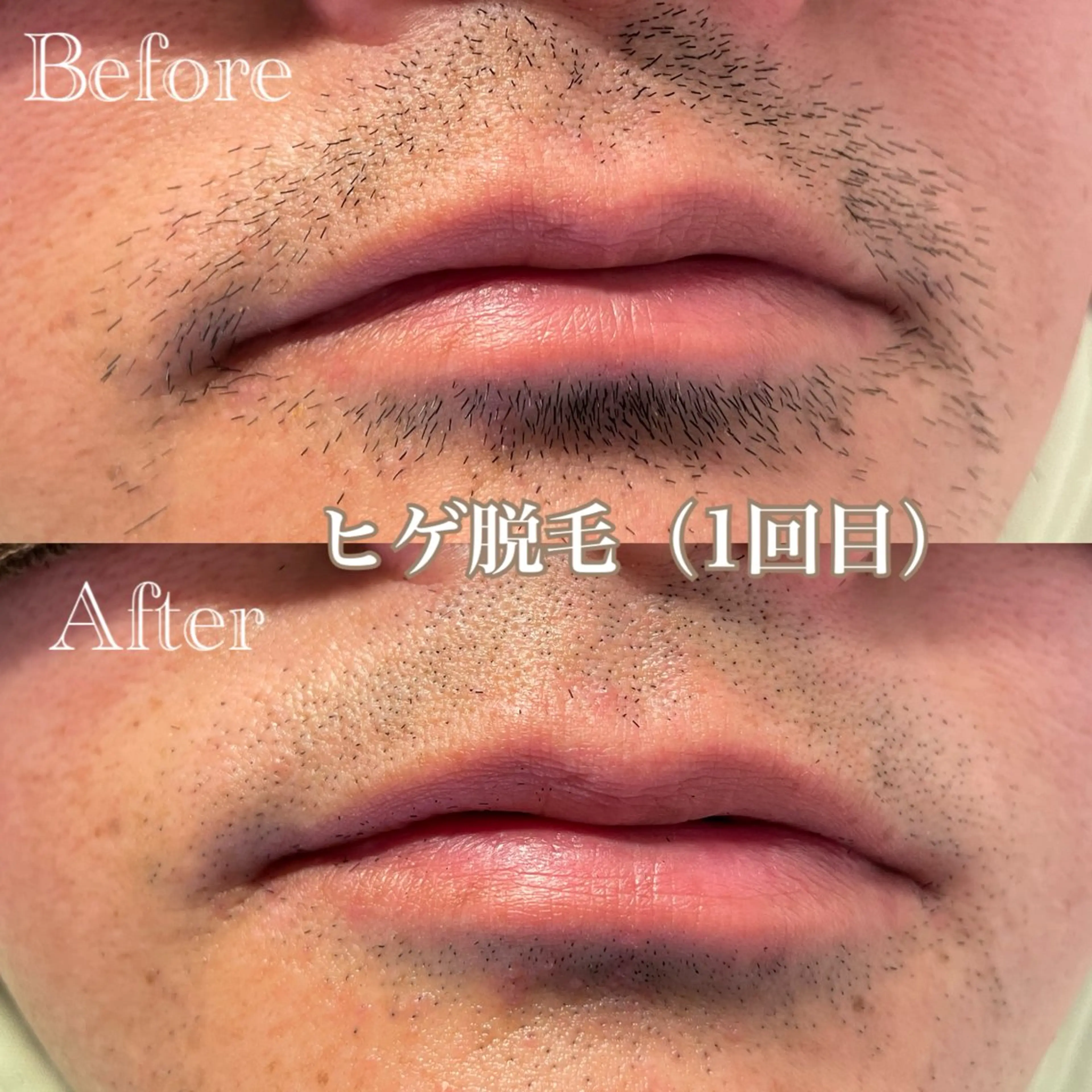 【人気No.1】メンズヒゲ脱毛 まずはお試し ¥1,980の写真