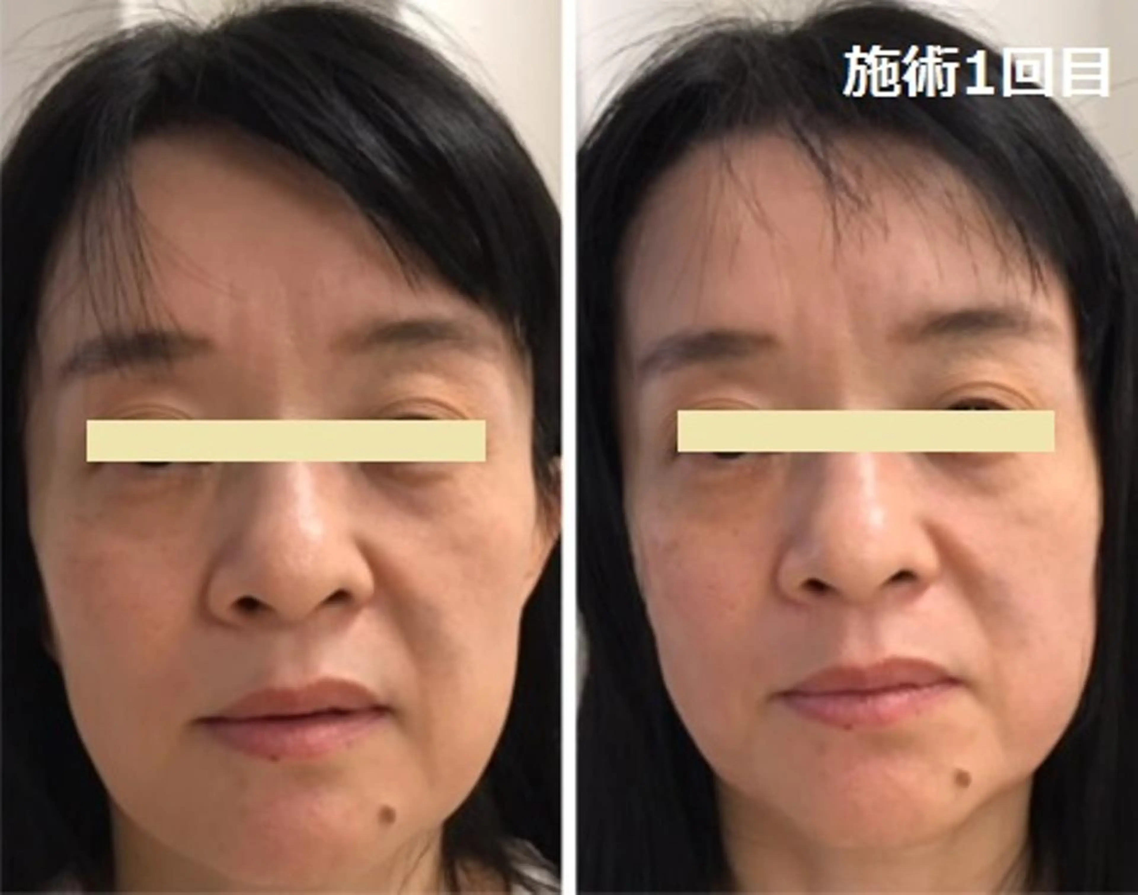 エステ 顔脱毛＆毛穴＆ニキビ 優良№1♪ヒロコ♪のエステ・リラクイメージ