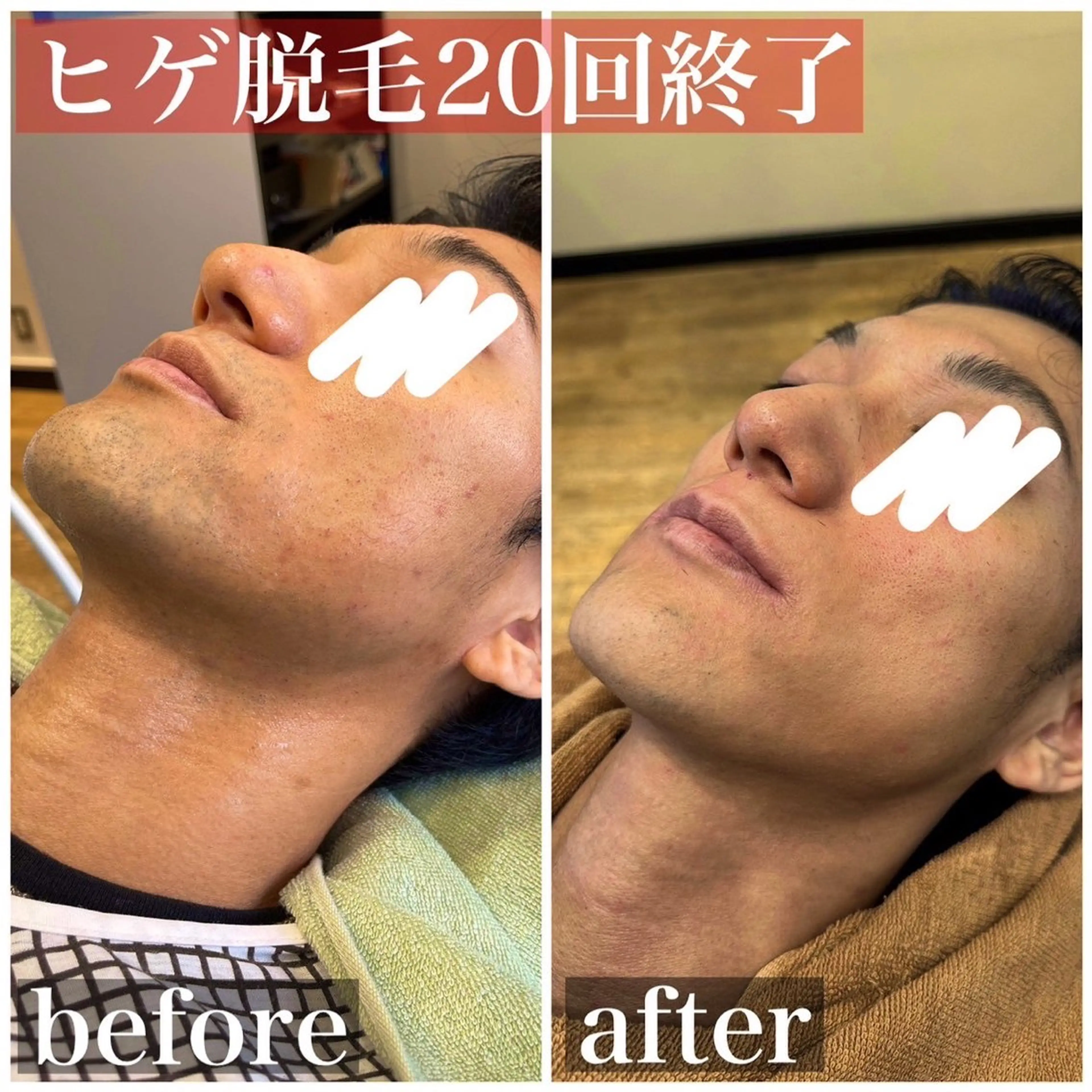 メンズ 脱毛 HAIRS YOSHIOKA所属・ヘアーズヨシオカ MENSヒゲ脱毛のエステ・リラクイメージ