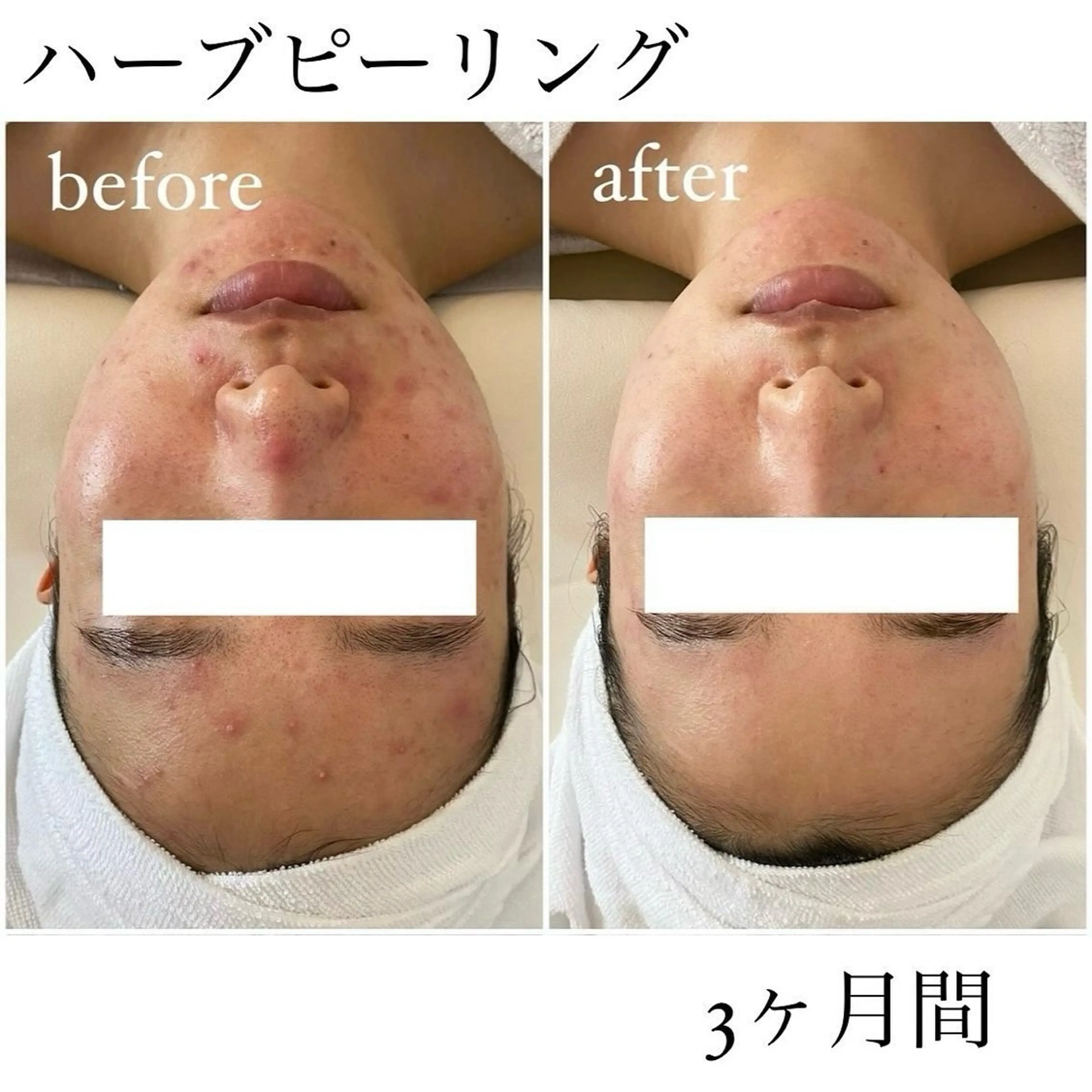 I'm -ｲﾑ-所属・肌質改善／ブライダル I'm.-イム-のエステ・リラクイメージ