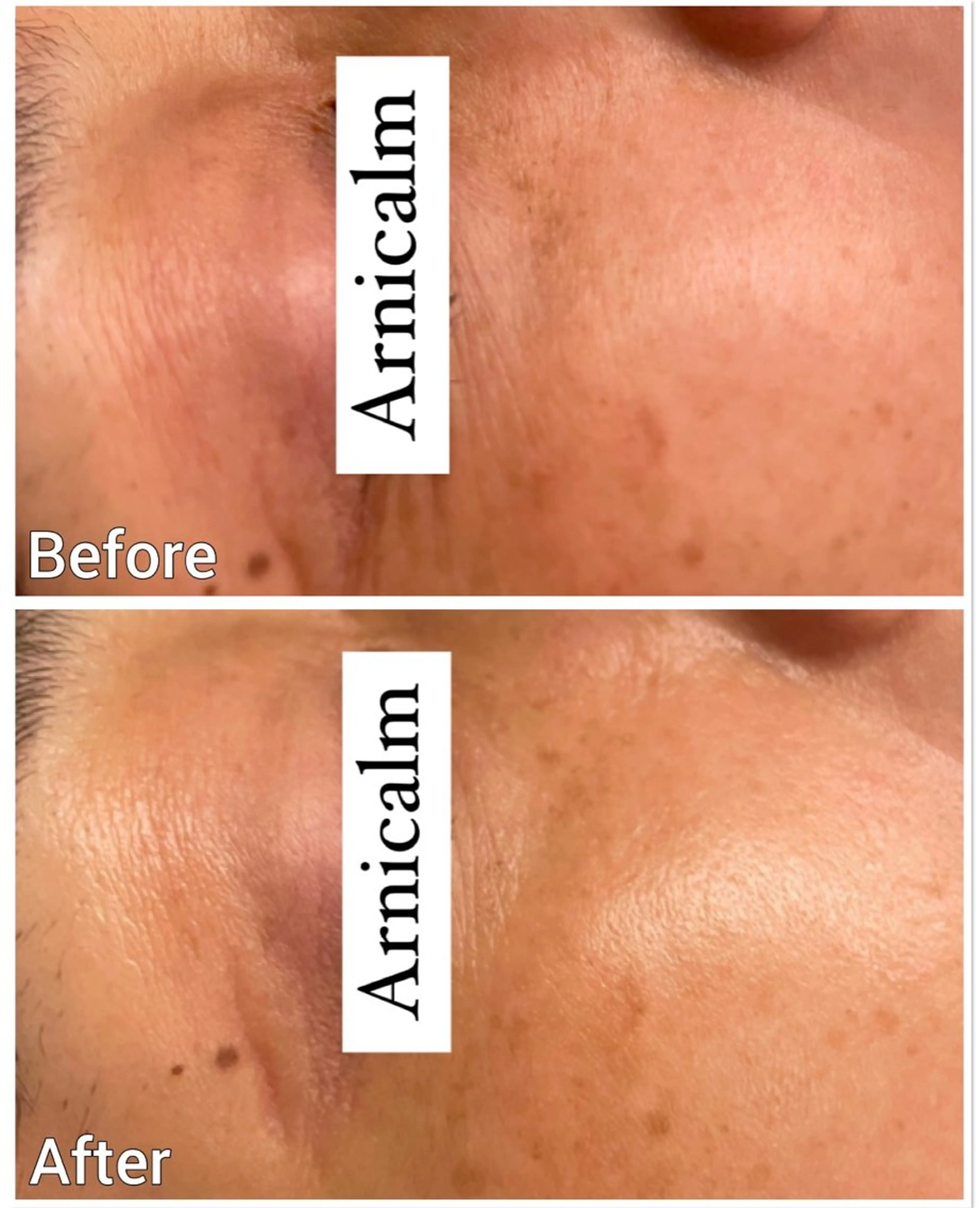 エステ ハーブピーリング 肌再生ピーリング/のエステ・リラクイメージ