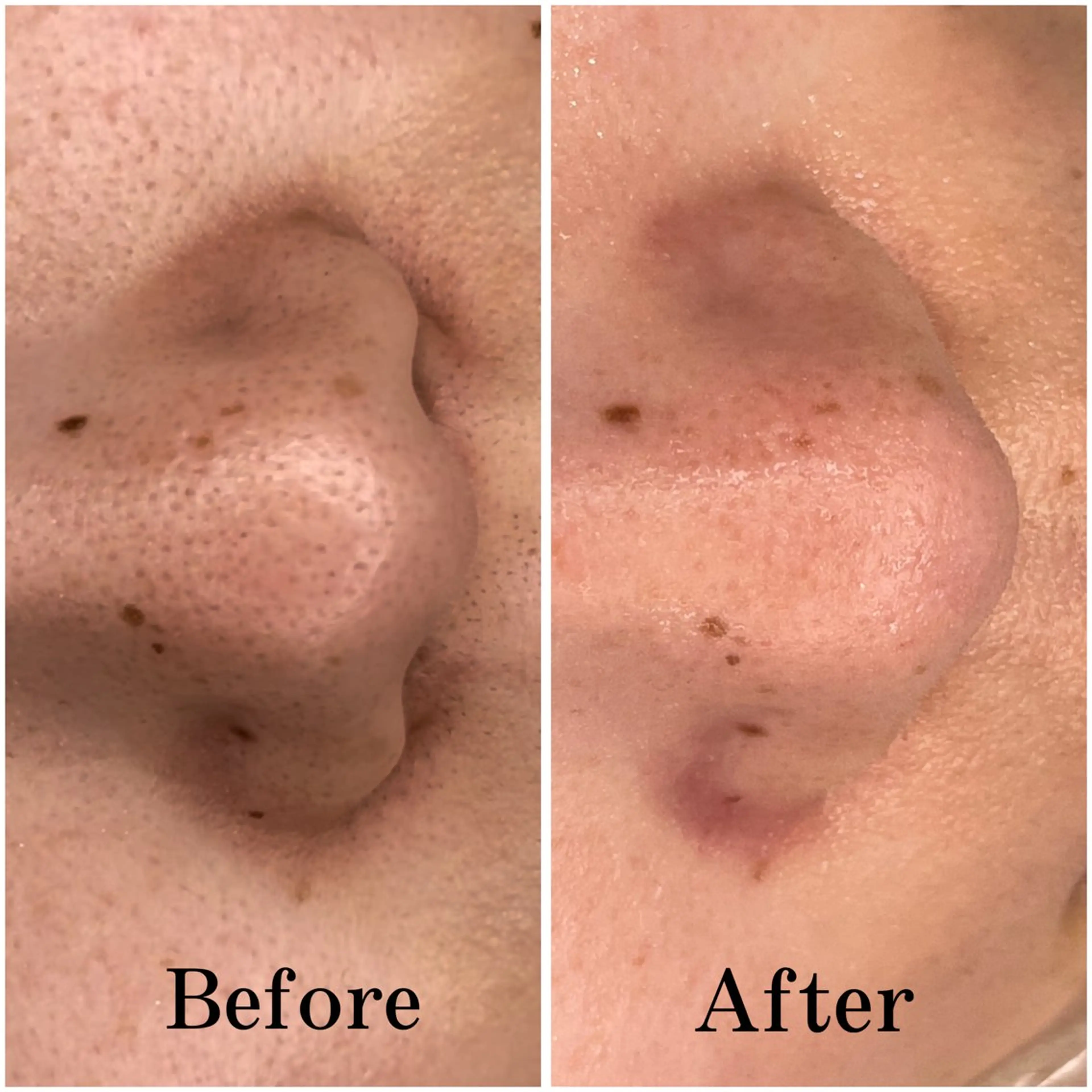 💛お顔剃り＋小鼻毛穴洗浄＋美白パックの写真