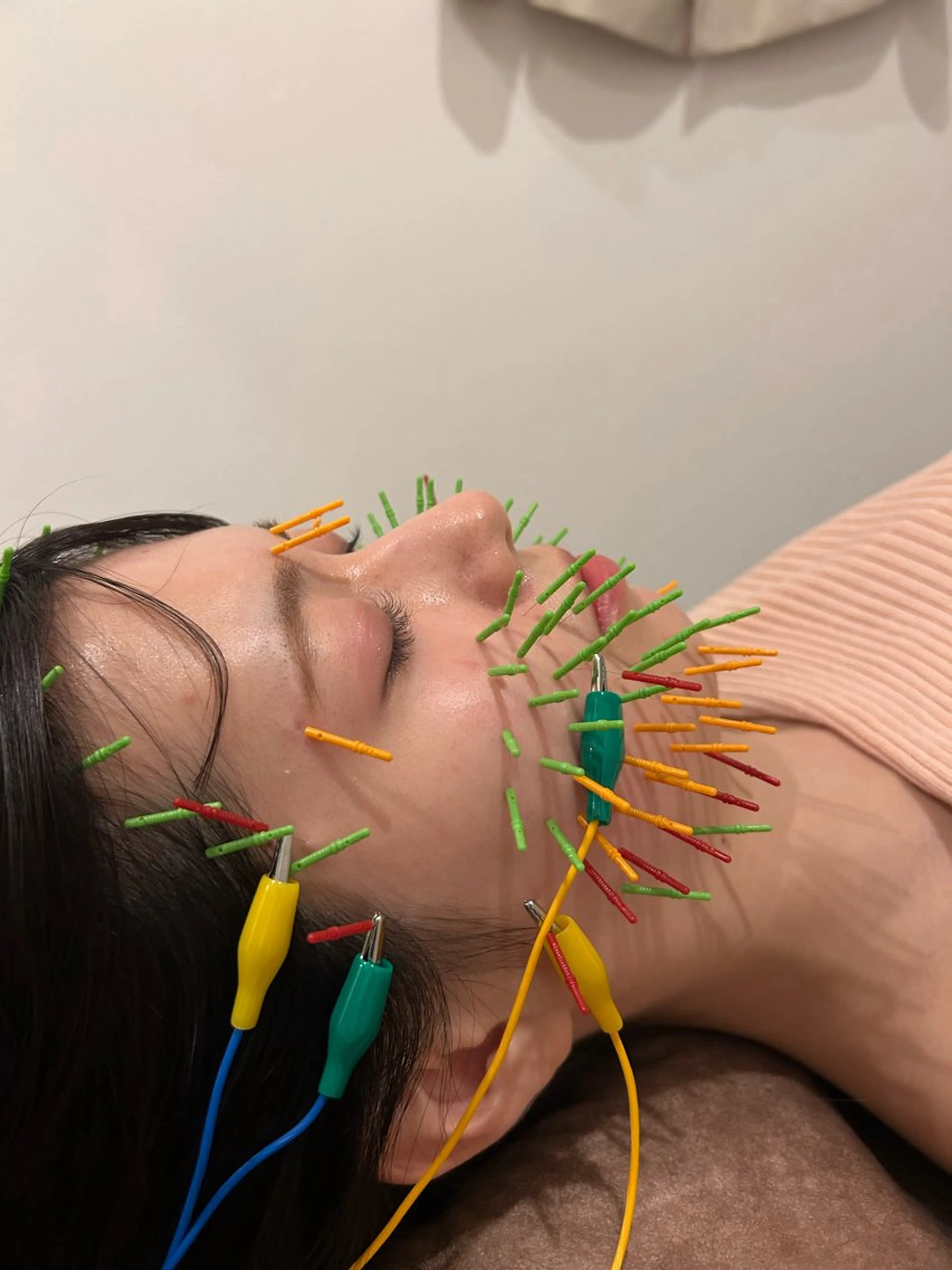 エステ リラク 美容鍼灸Solana所属・肌質改善×美容鍼 ゆいのエステ・リラクイメージ