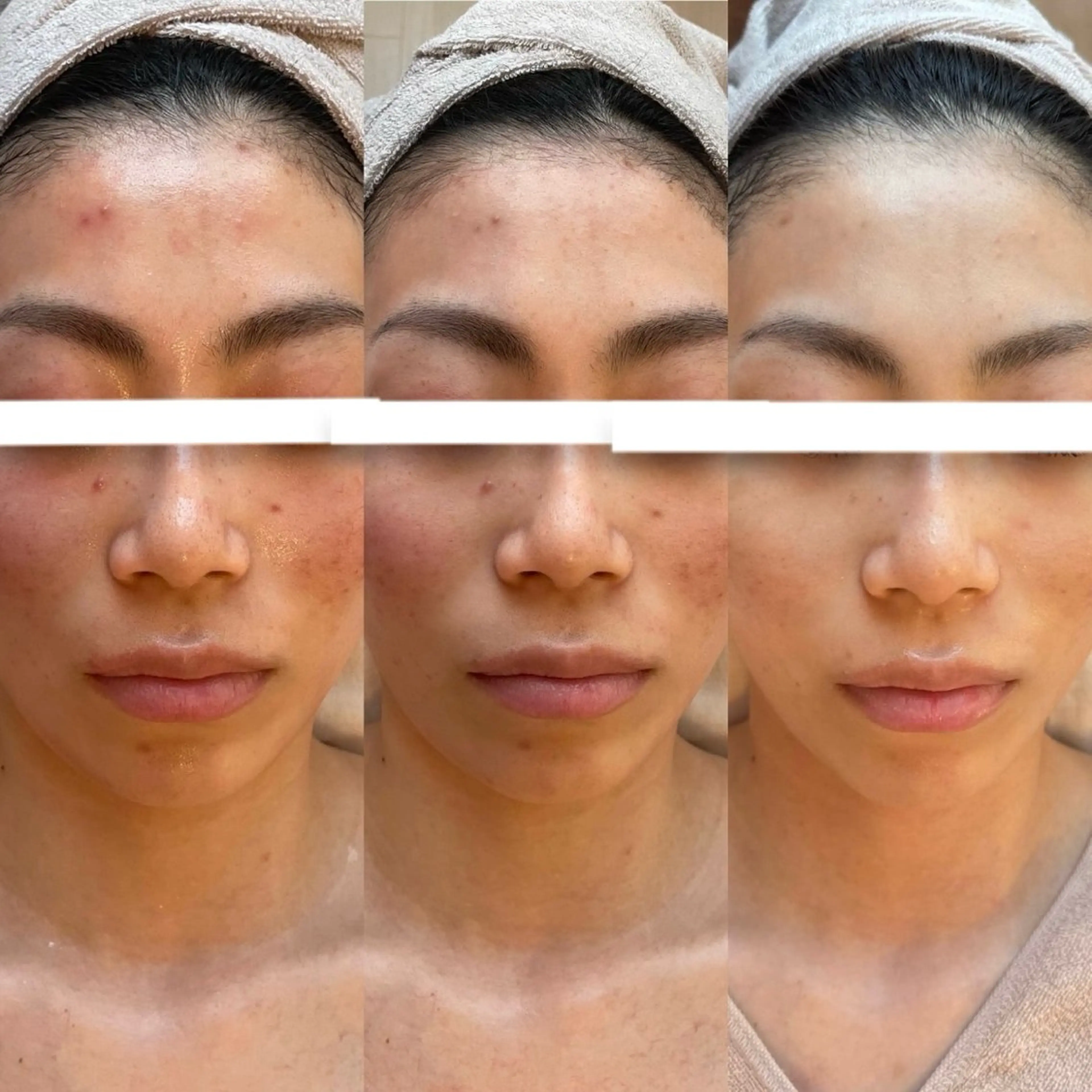 たるみ/シミ/シワ/毛穴/ニキビ跡【幹細胞Lit】臍帯由来幹細胞×高純度エラスチン導入!!(顔、首)の写真