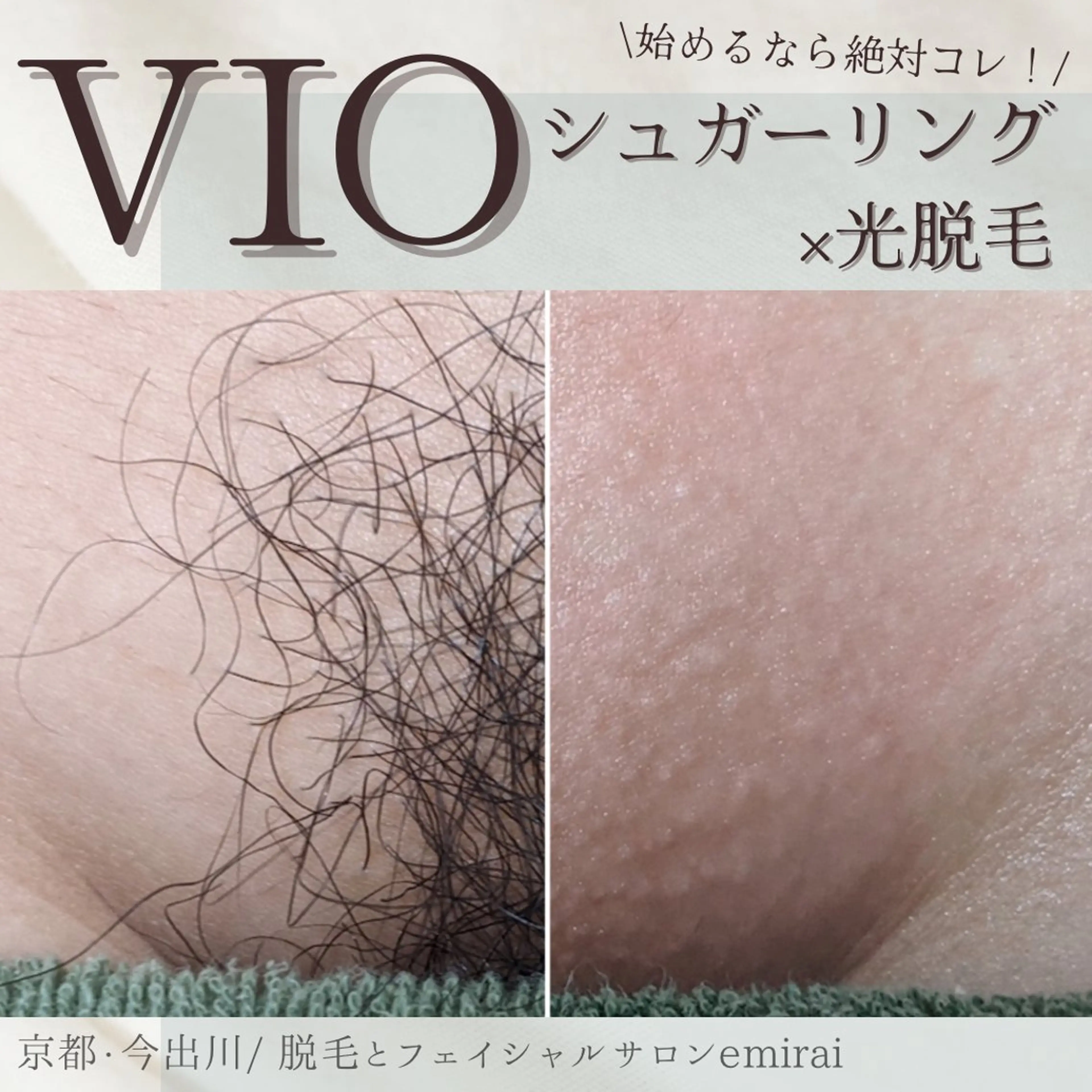 人気Ｎｏ.1✨シュガーリング🍯+最新式光脱毛✨で当日からつるつる！チクチクしないVIOmix脱毛🍯💕の写真