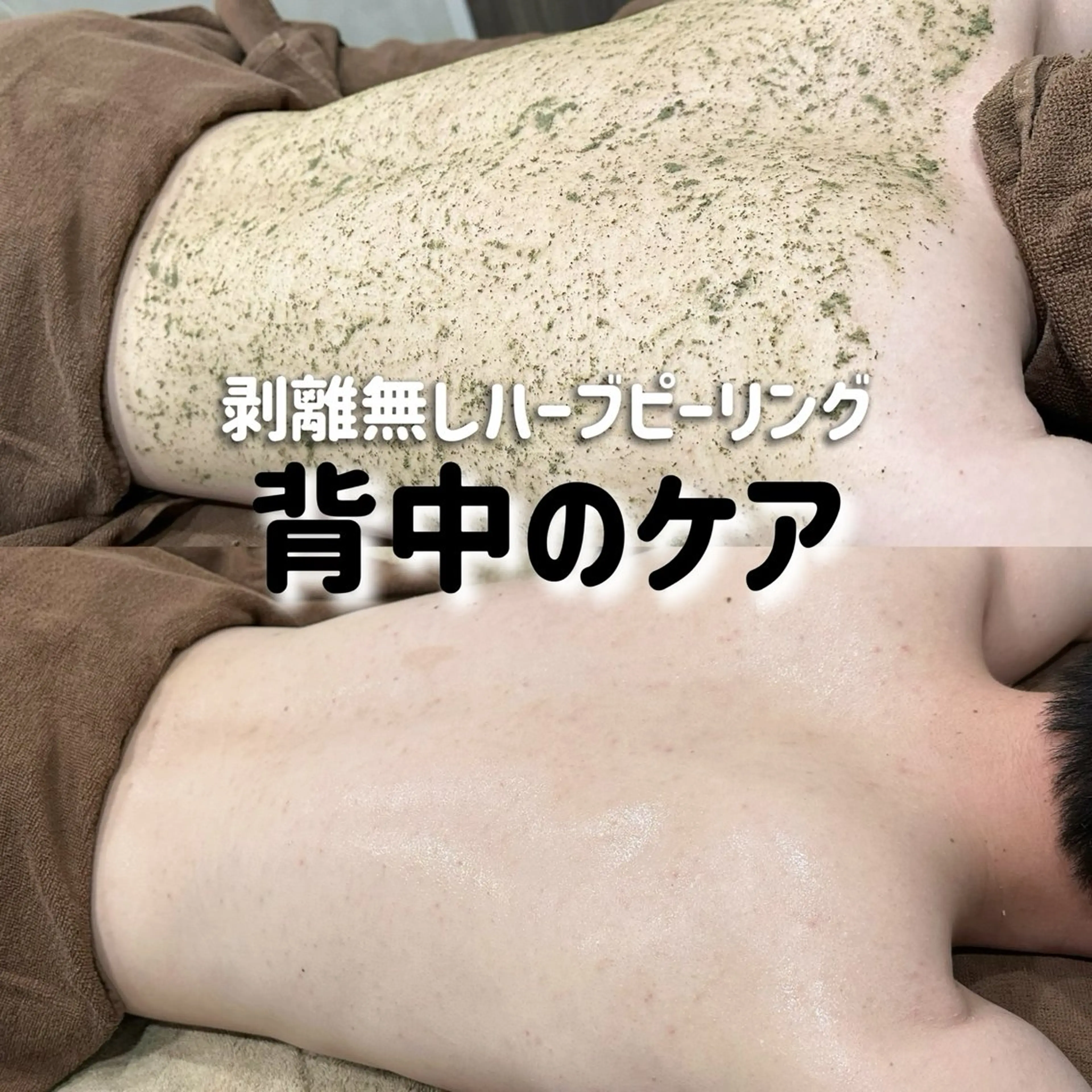 【背中半面or美尻or二の腕】ハーブピーリング🌿の写真