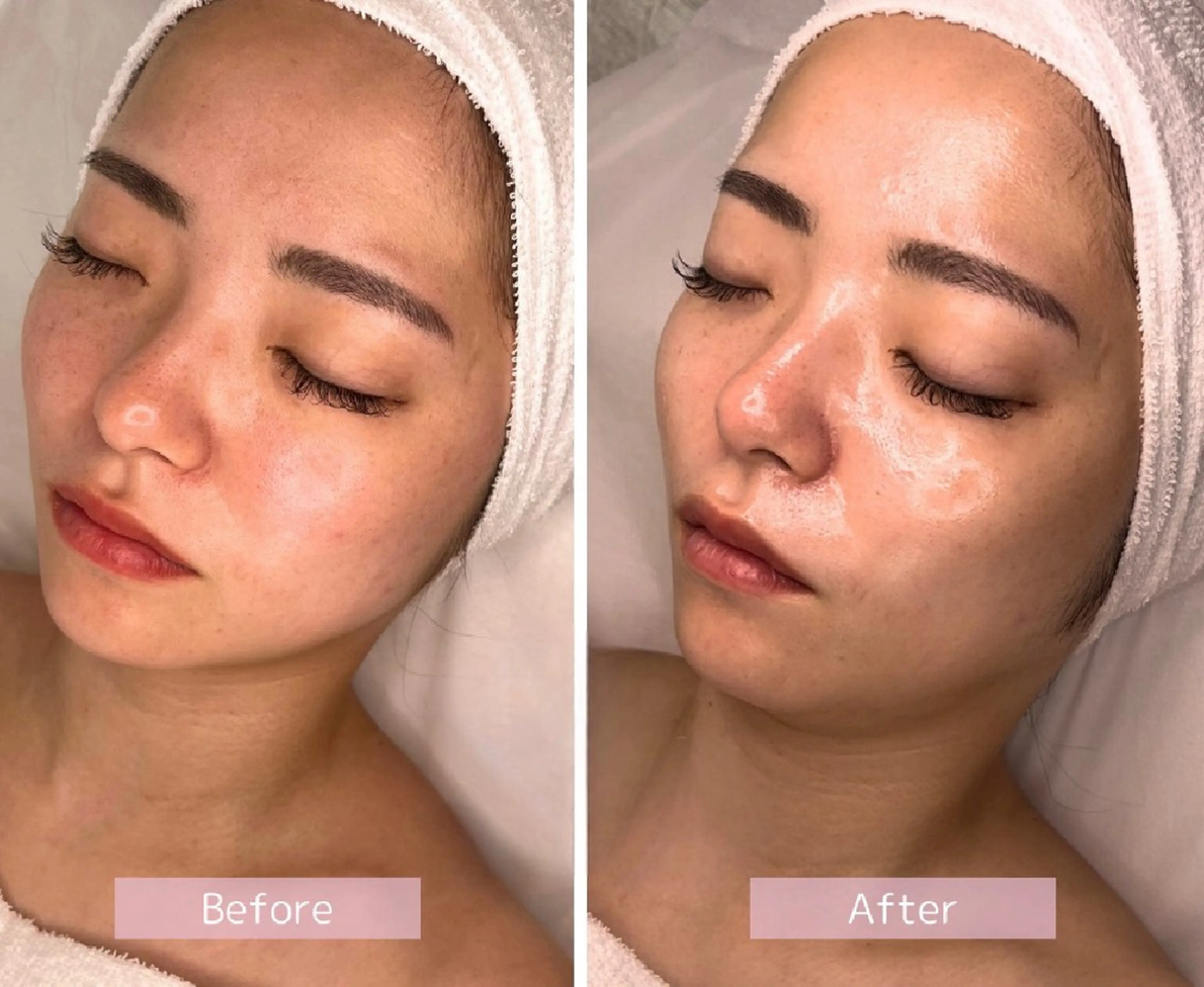 毛穴レス水光肌へ☆エステ版ダーマ×選べる韓国生美容液導入♪の写真