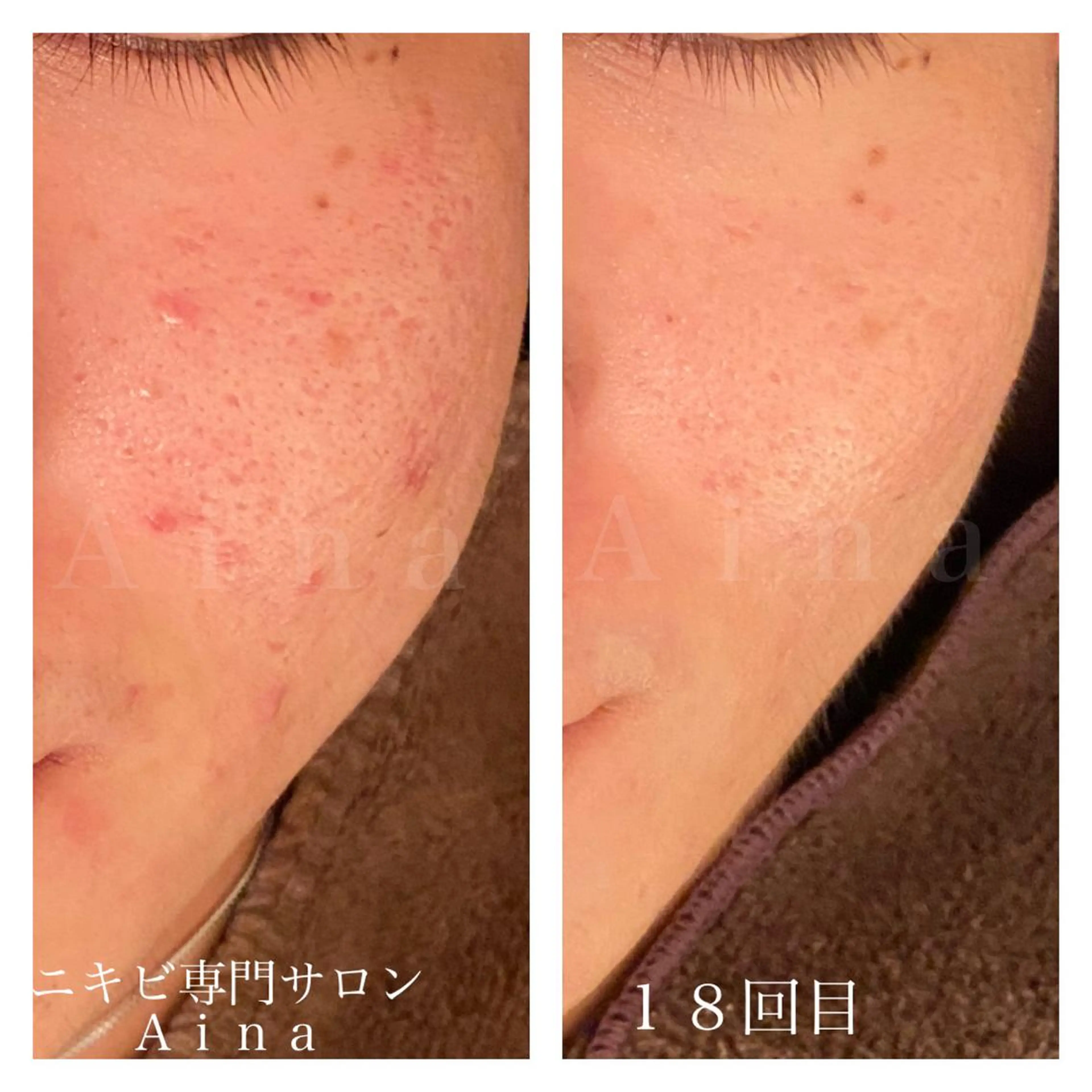 ショート カラー パーマ ヘアアレンジ メンズ キッズ ネイル マツエク・マツパ 赤色 ニキビ跡専門サロン Ａｉｎａのエステ・リラクイメージ