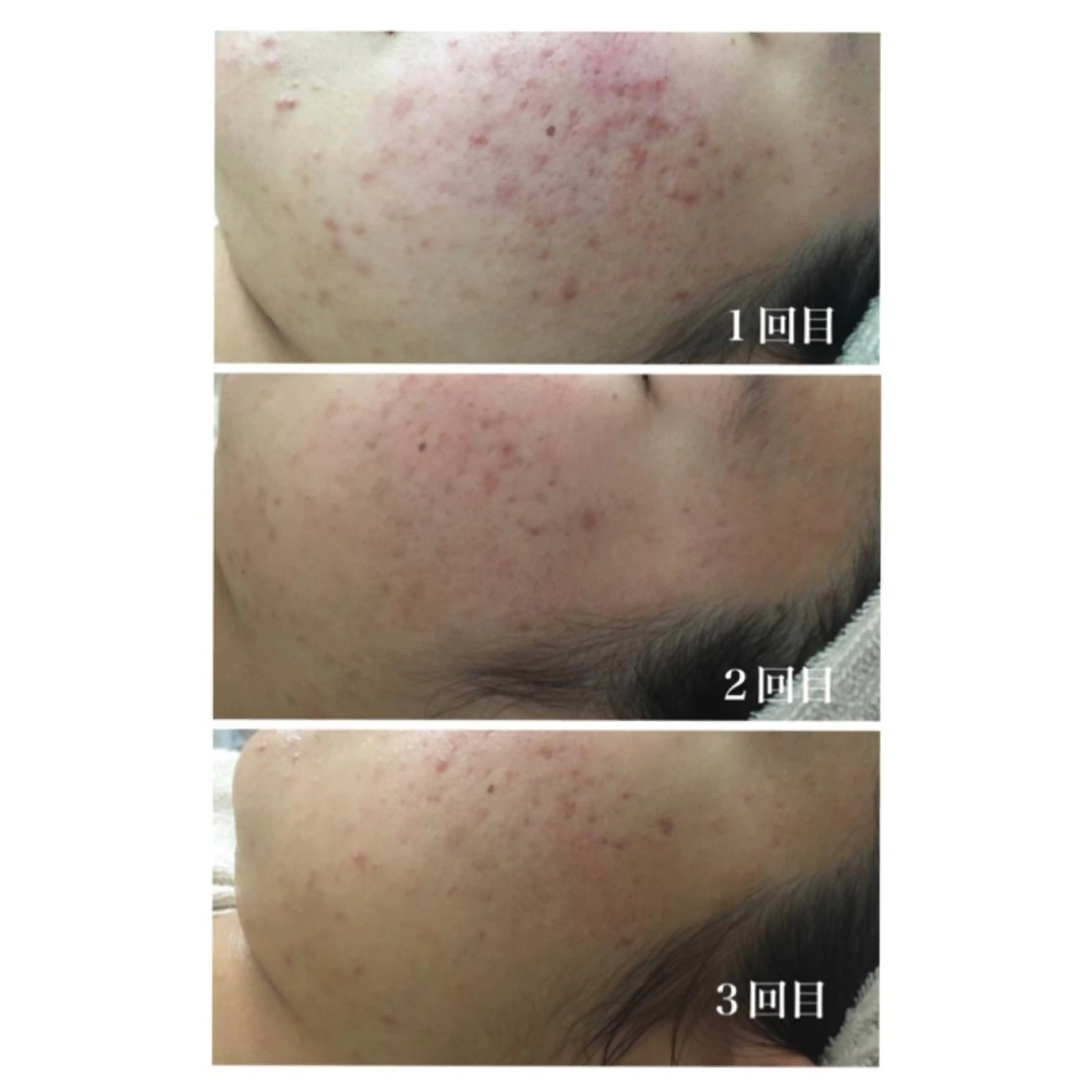 Meupニキビ専門店 背中/ハーブ/肌管理のその他イメージ