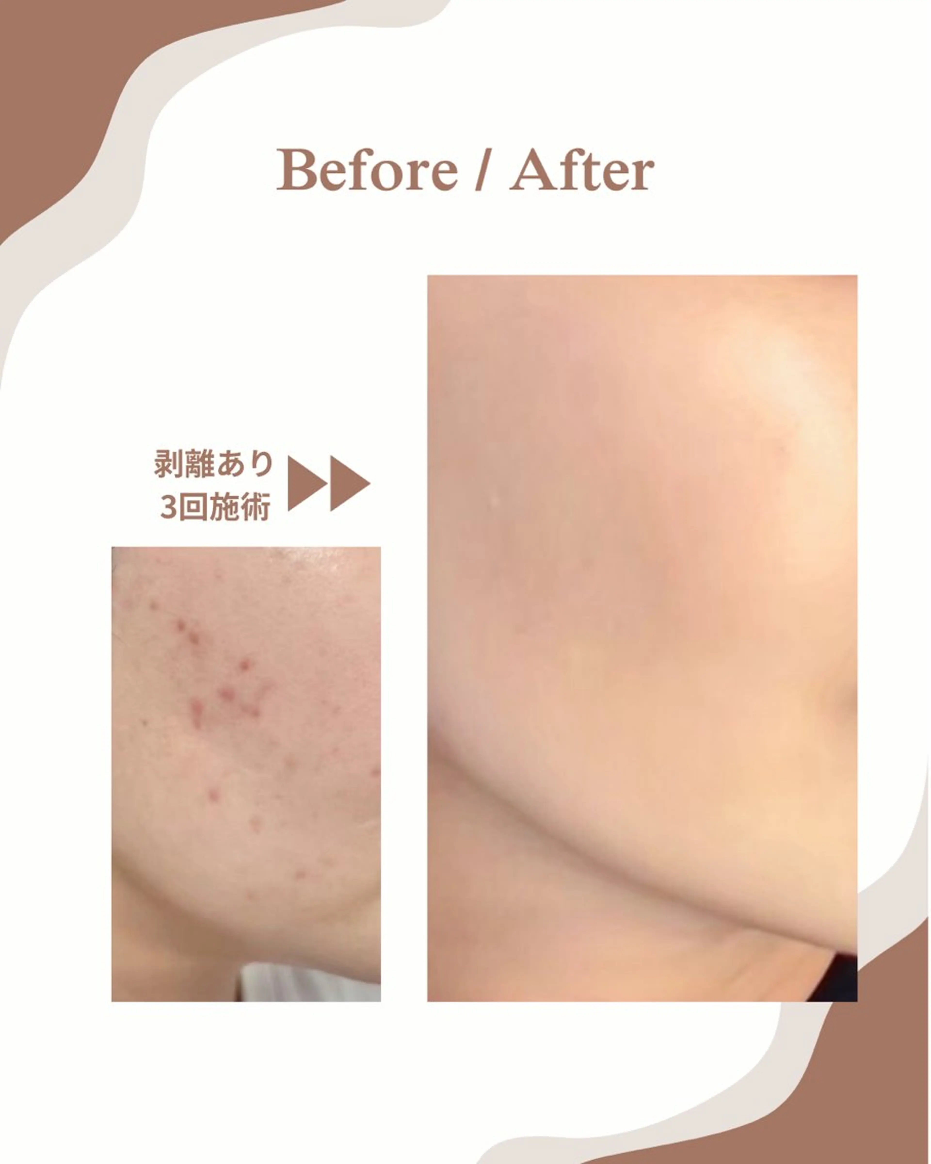 エステ myherb所属・ニキビ肌改善サロン myherb🌿のエステ・リラクイメージ