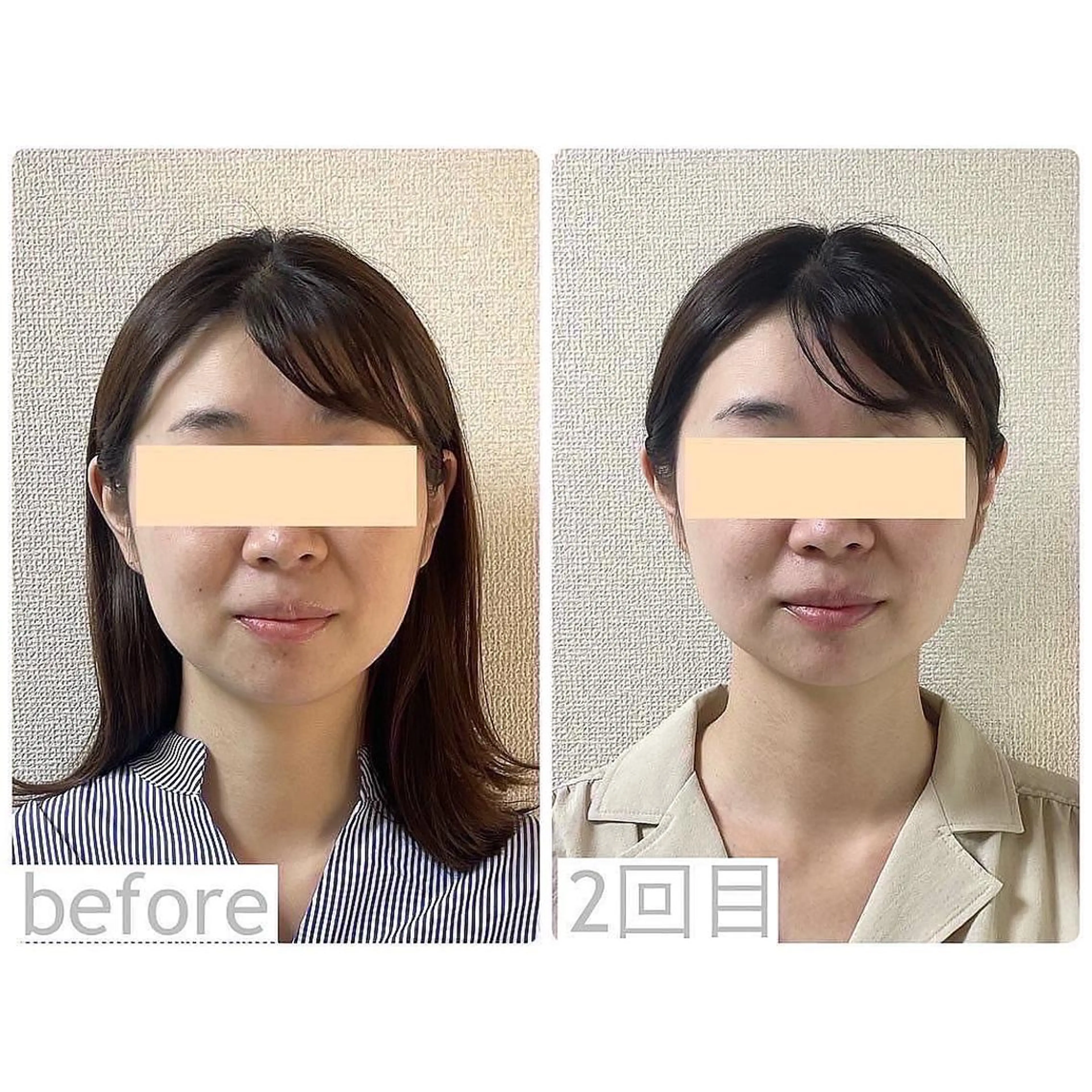 🦩丸顔のお悩みにむくみスッキリ✨痛くない小顔矯正💫【クレンジング＋小顔矯正＋保湿パック】の写真