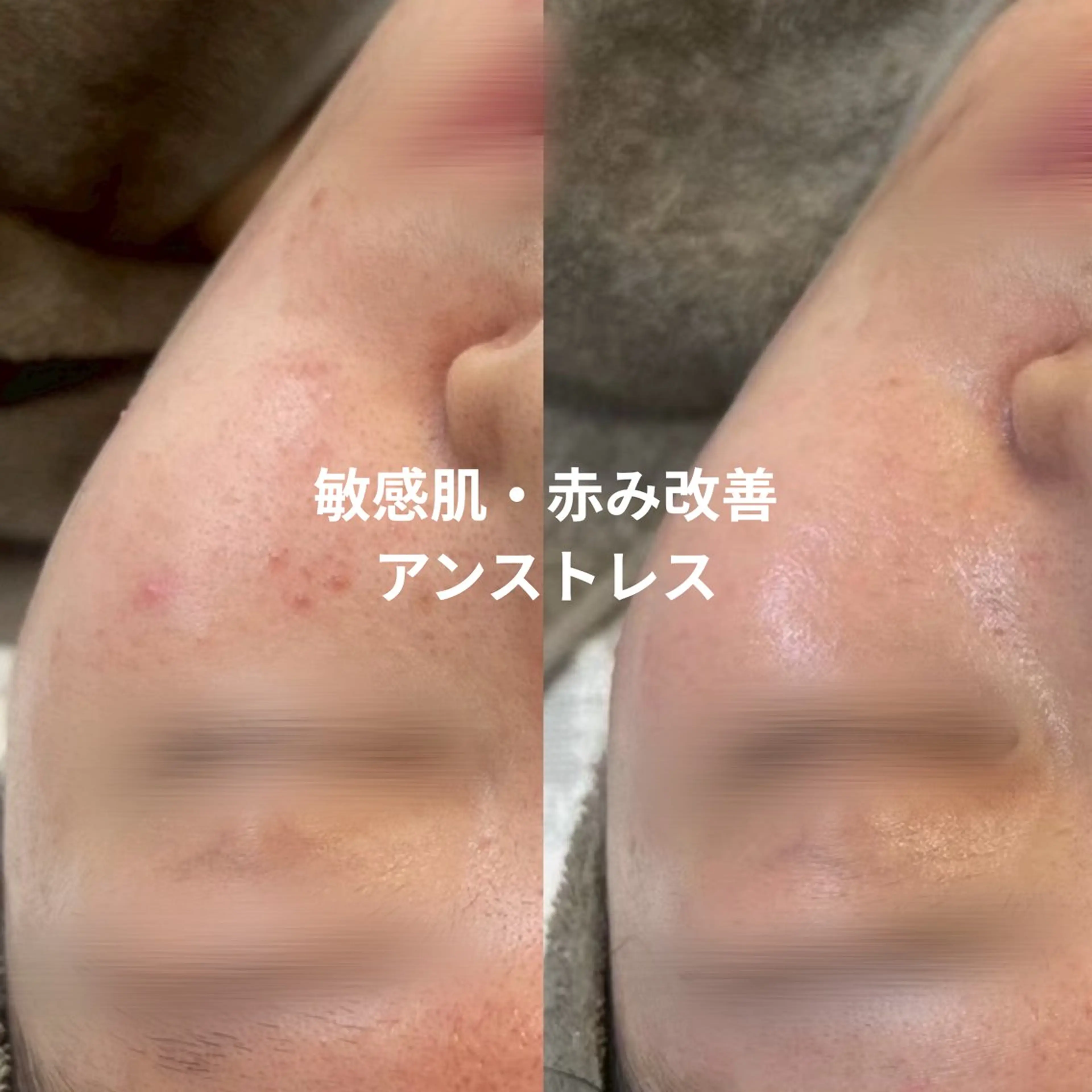 クリスティーナ アンストレス|赤み・ゆらぎ肌の鎮静ケアの写真