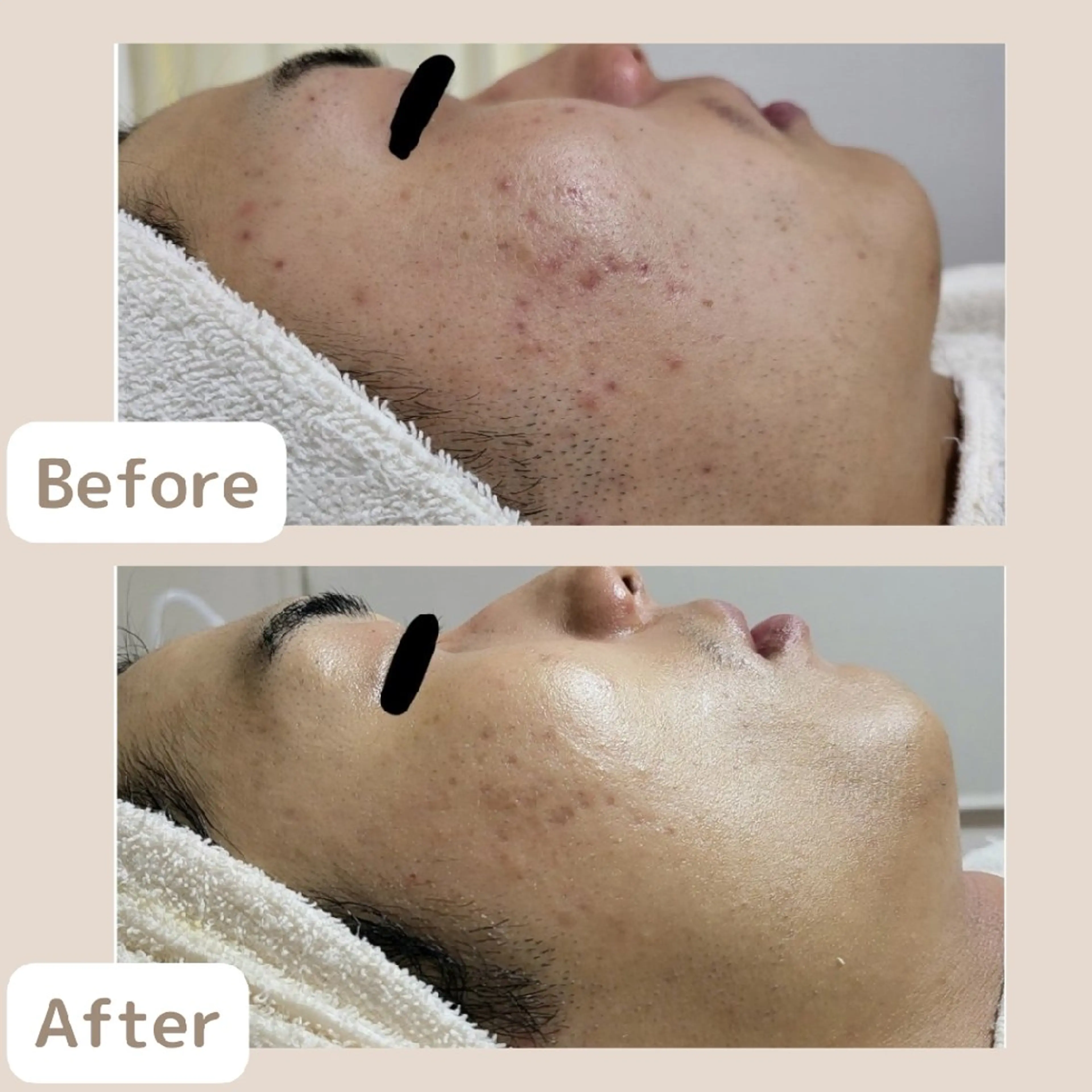 メンズ レチノール/ニキビ/ 毛穴ケア 浅川のエステ・リラクイメージ