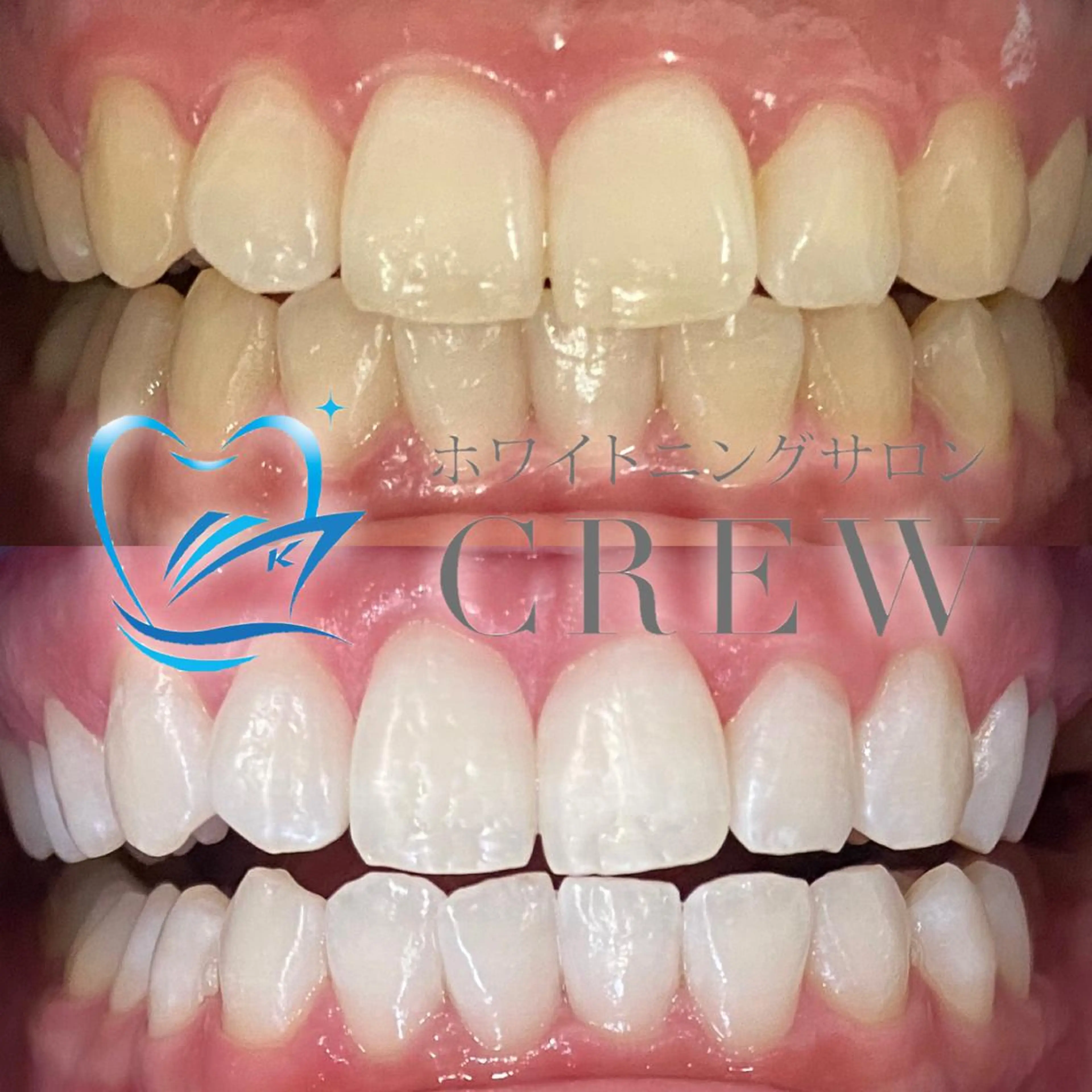 🦷minimo限定価格🦷12分×2照射 7500→2,500円❣️の写真