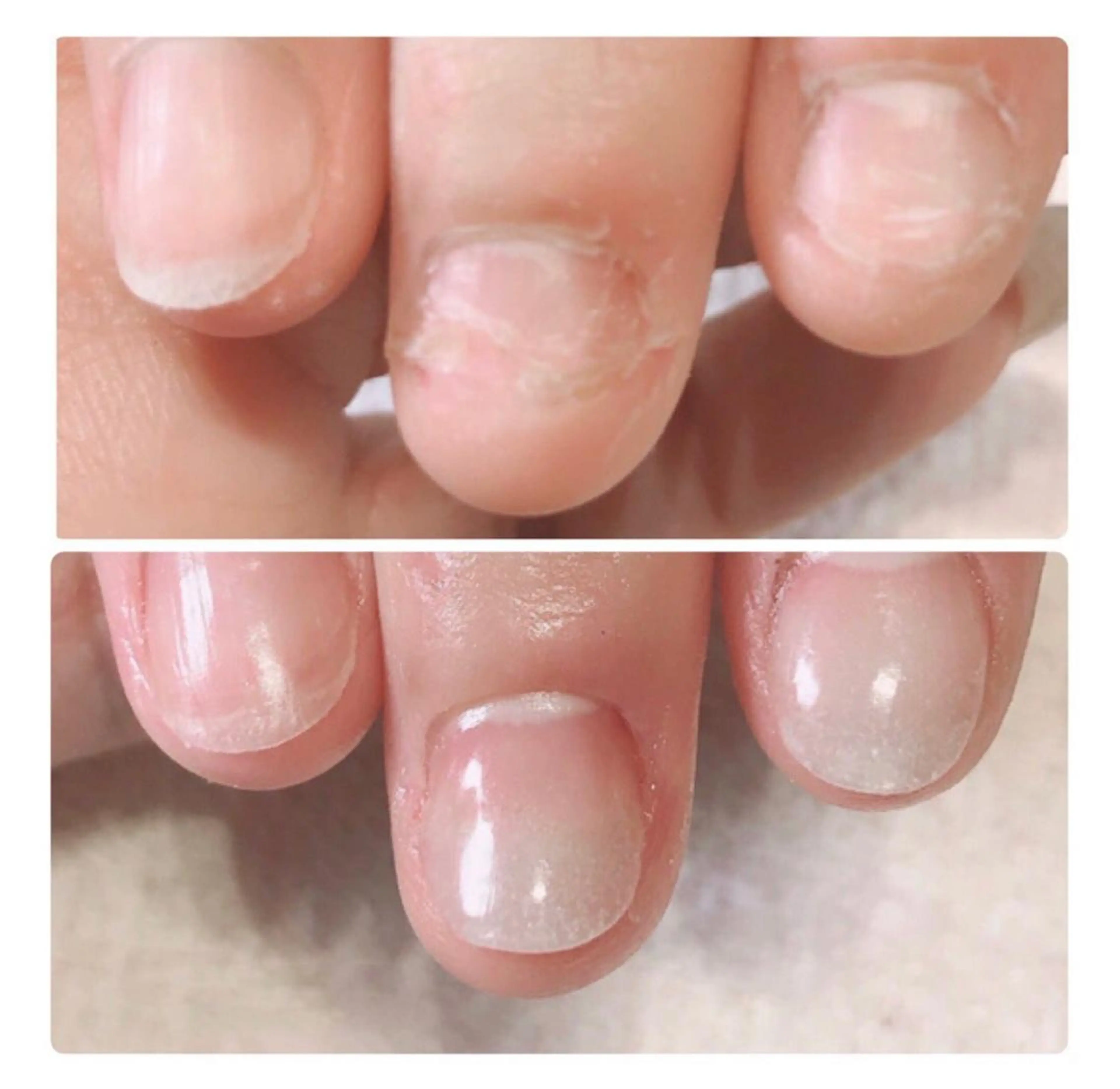 💕【深爪噛爪】矯正コース★長さ出しのみ(10本）*オフ無しの写真