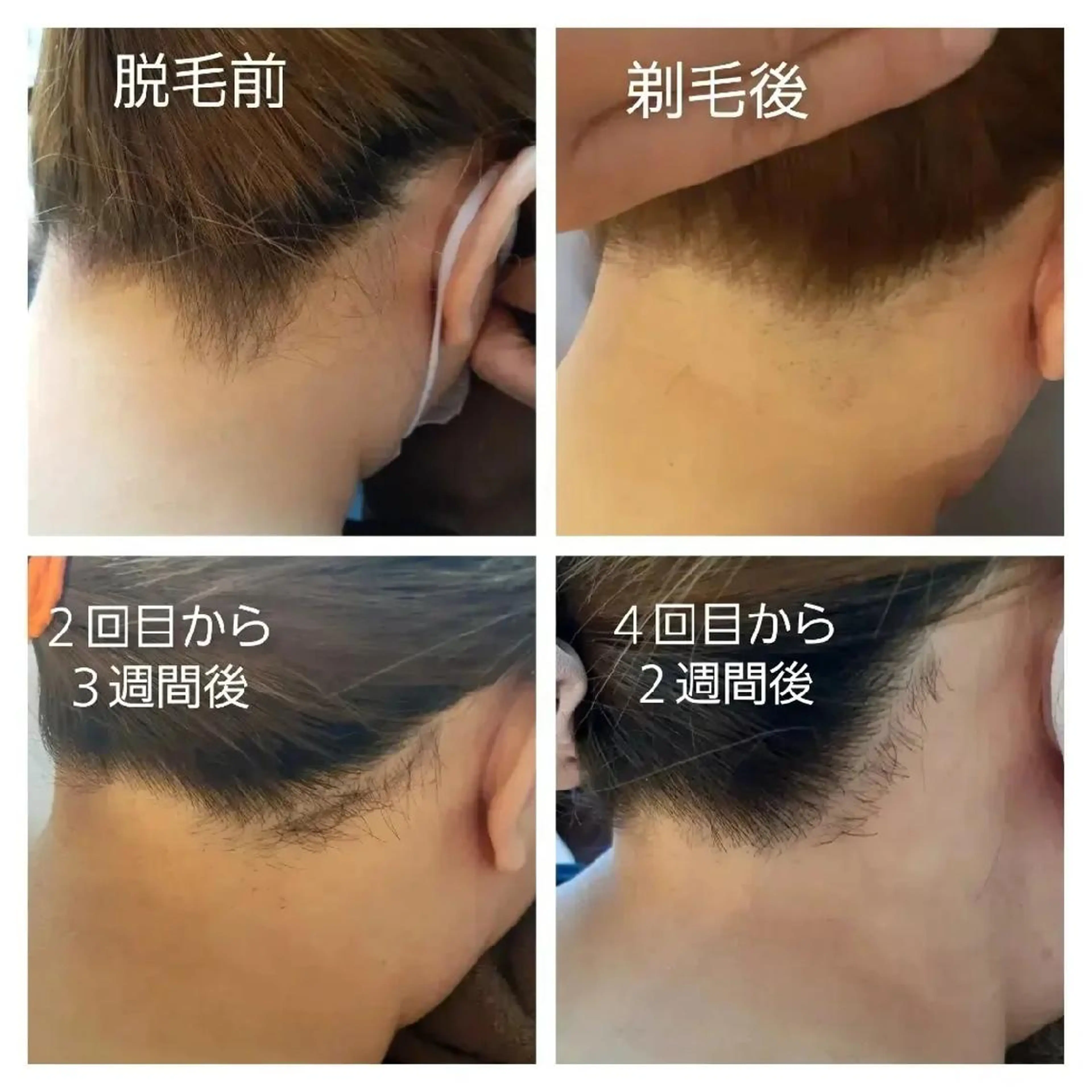 素肌美人♪効果抜群‼️全身脱毛(顔、vio含む)の写真