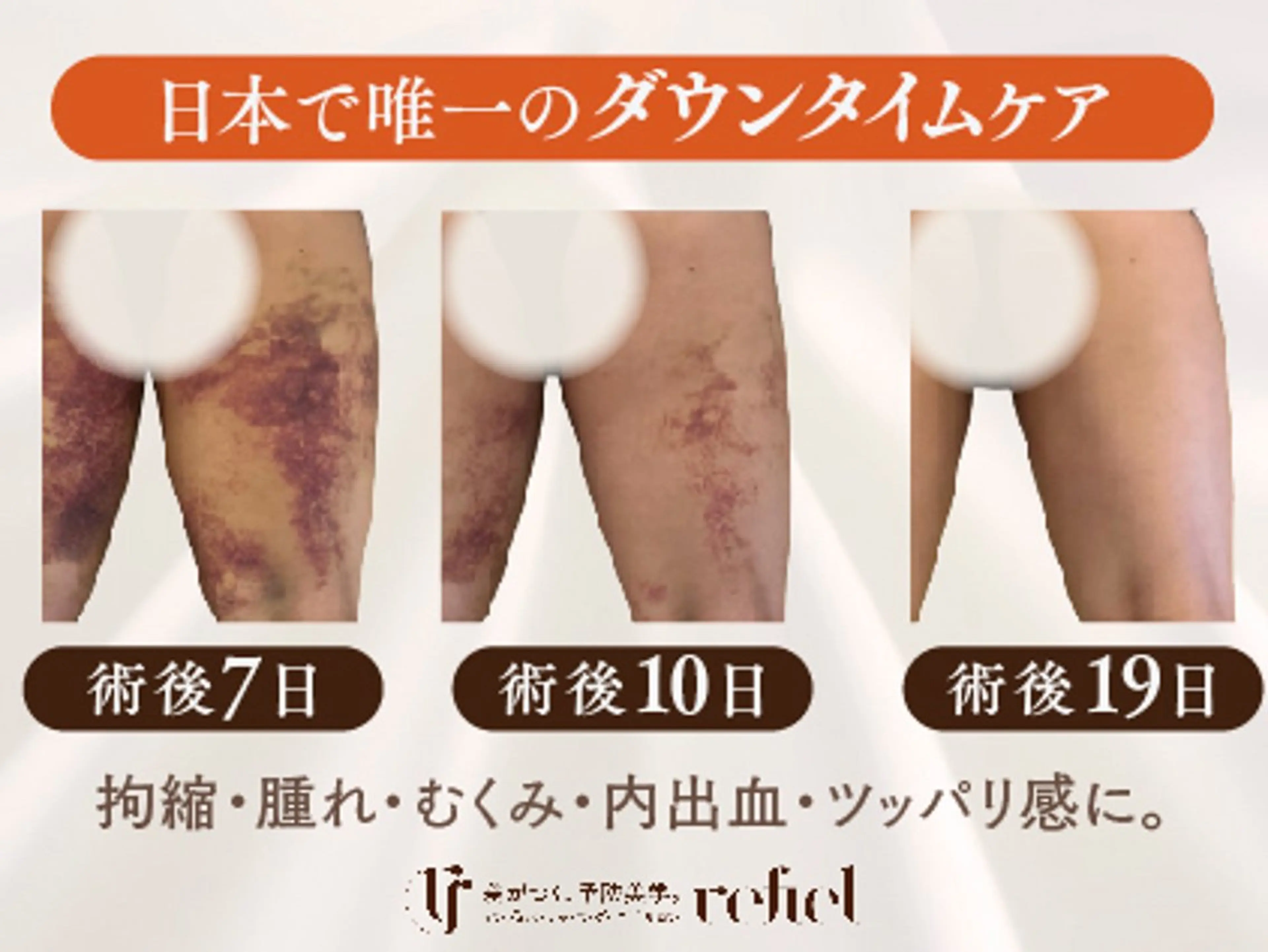 【モニター募集】　日本唯一のダウンタイムケア⭐︎ 脂肪吸引｜拘縮｜むくみ｜腫れ｜内出血の写真