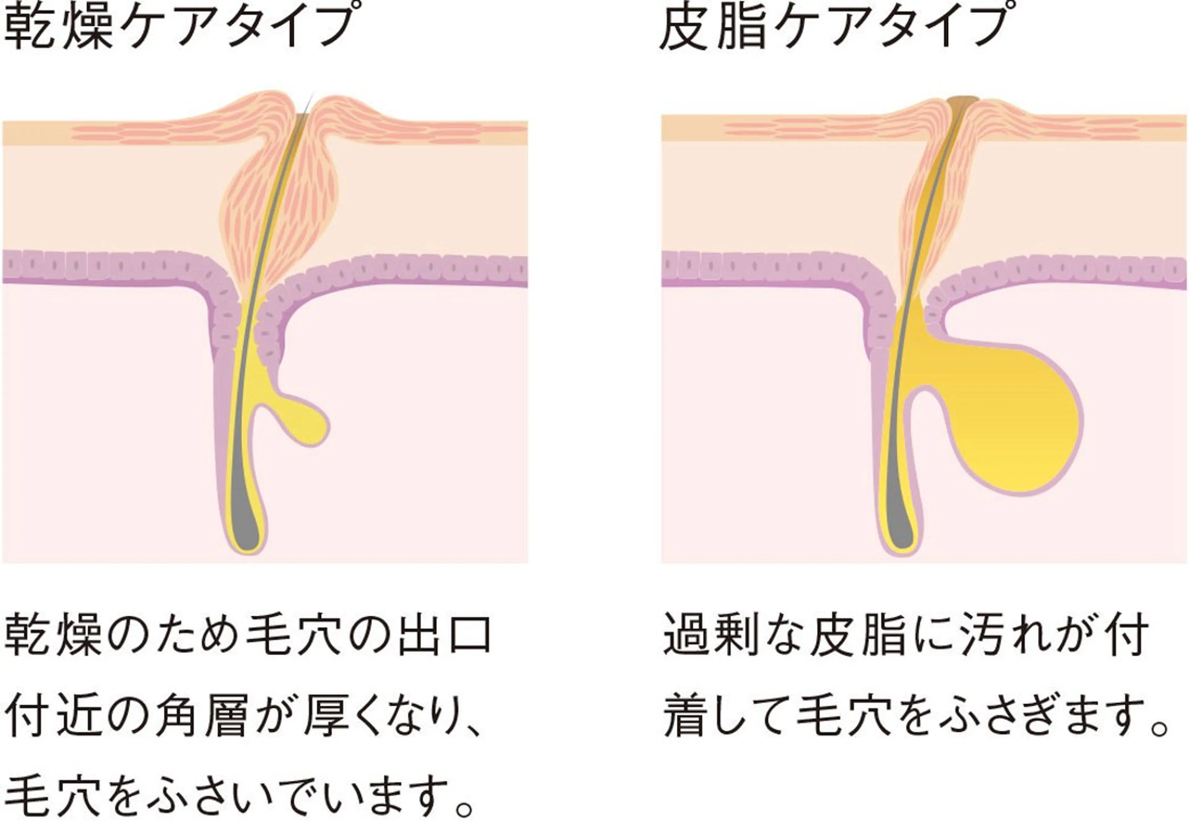 ニキビでお悩みの方向け。ポーラの肌分析　お肌に合わせたサンプルプレゼント🎁の写真