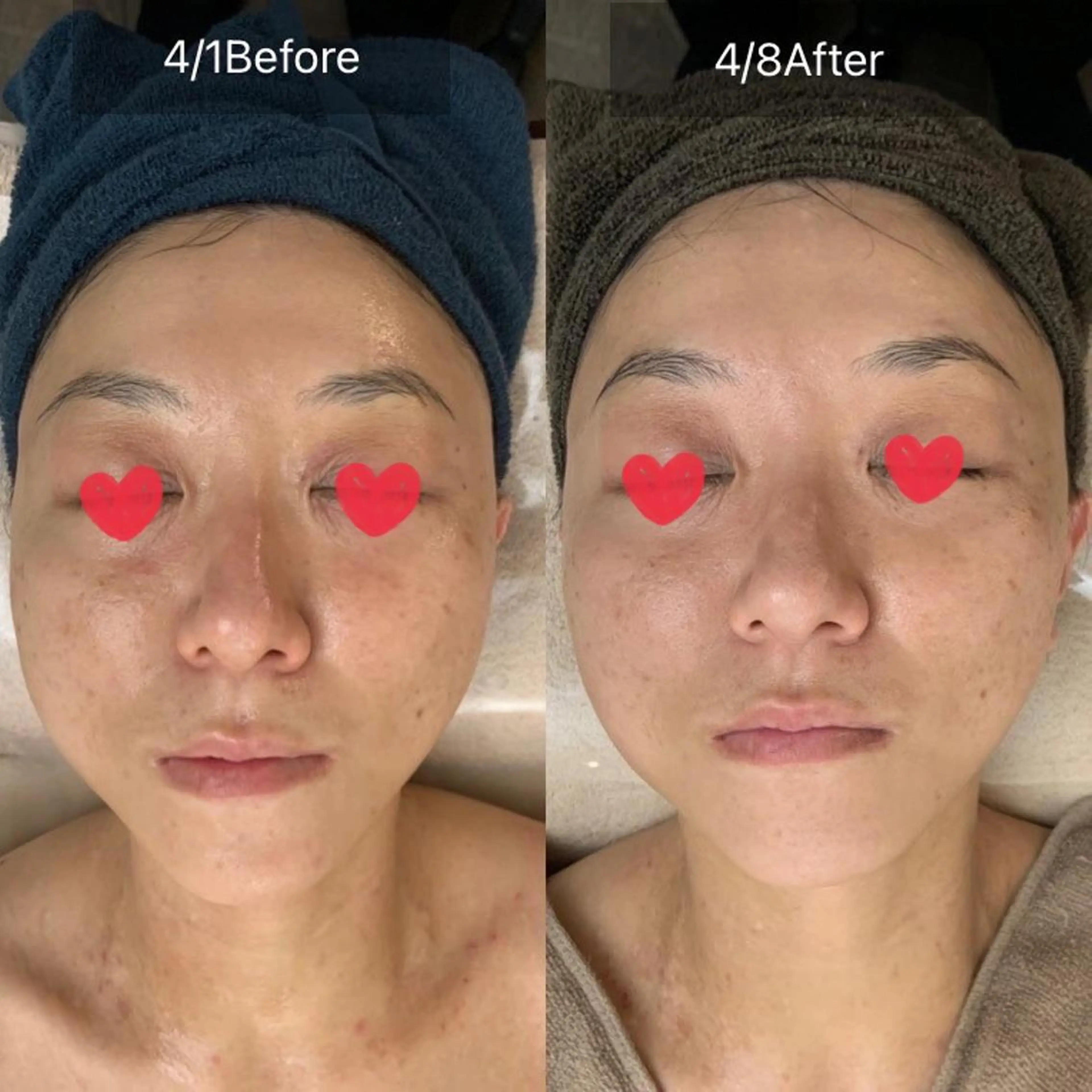 本格肌質改善★グランプリ受賞グリーンピール5Days体験（1Dayの5倍ハーブ）2回コースの写真