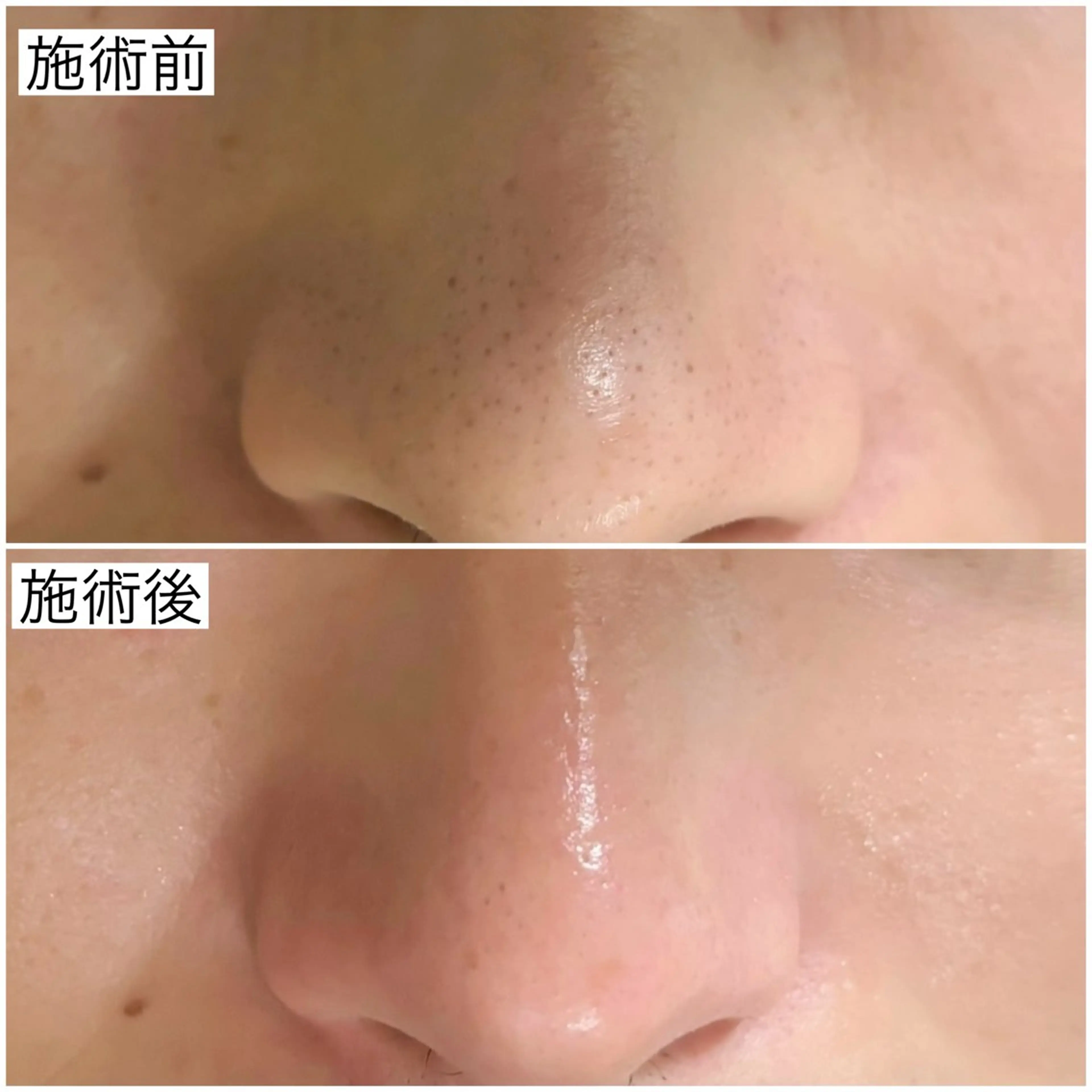 【特別価格】毛穴洗浄コースの写真