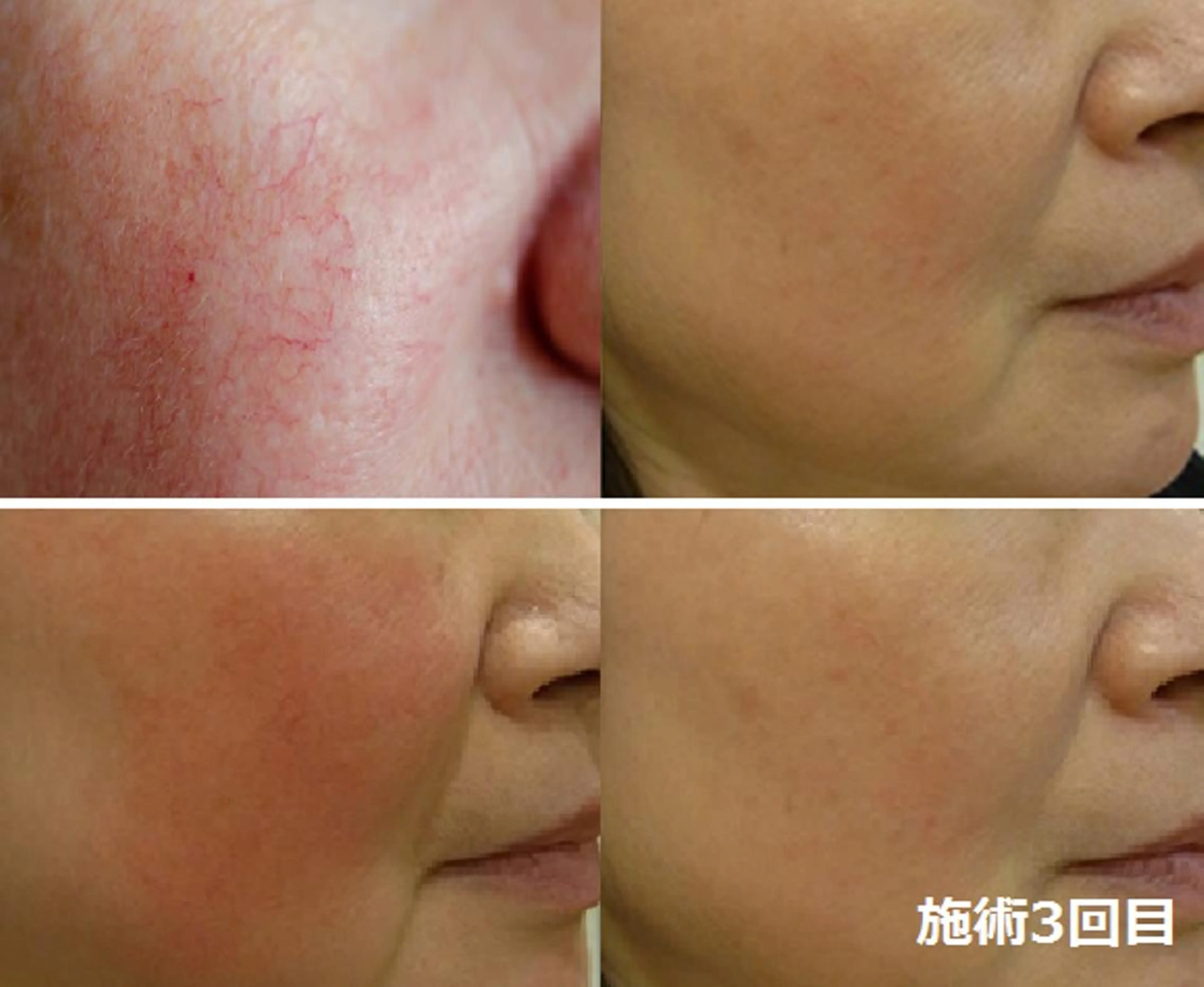 エステ 全身脱毛＆VIO脱毛 紹介率№1♪リナ♪のエステ・リラクイメージ