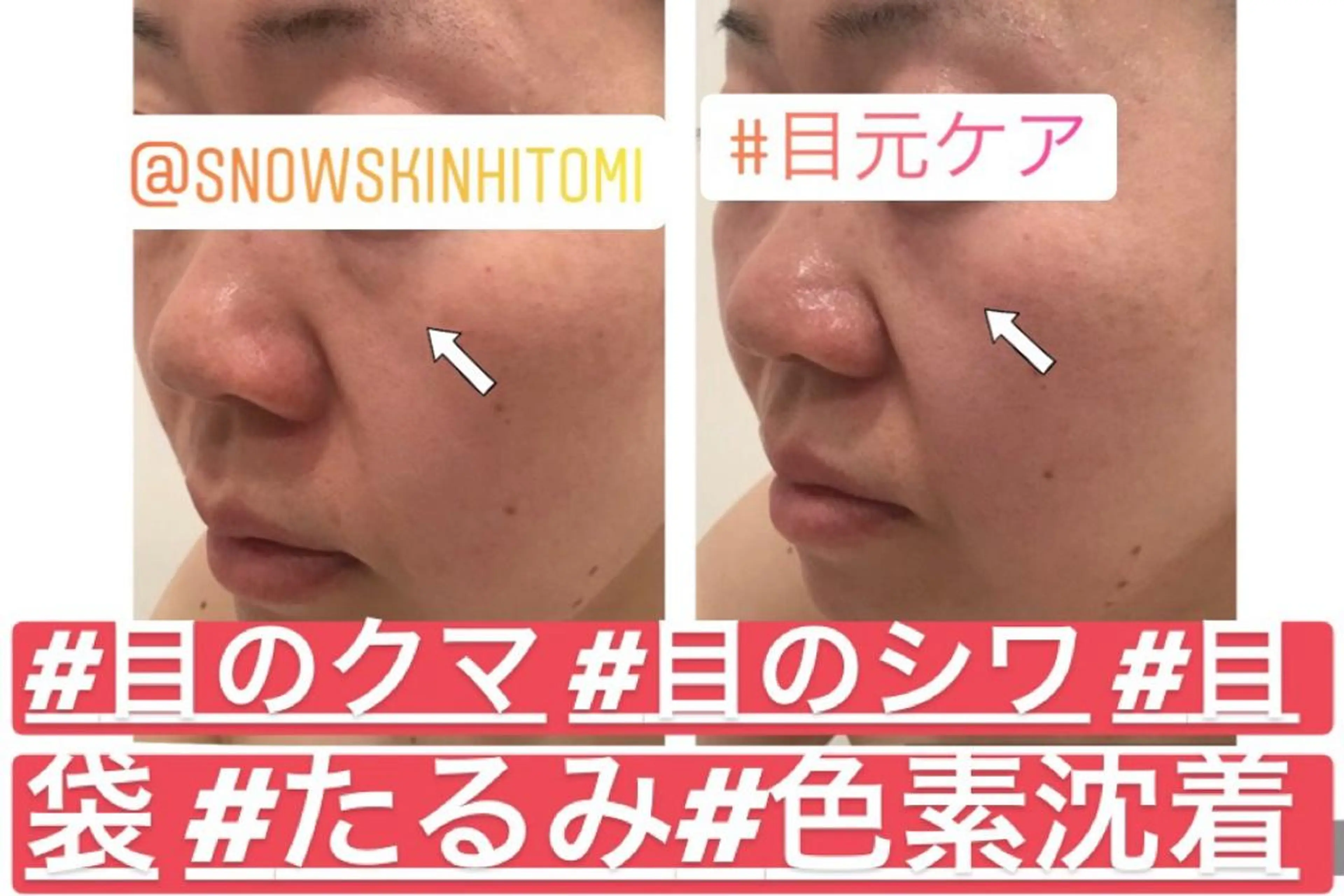 エステ リラク ニキビ/肌質改善専門 Snow skinのエステ・リラクイメージ