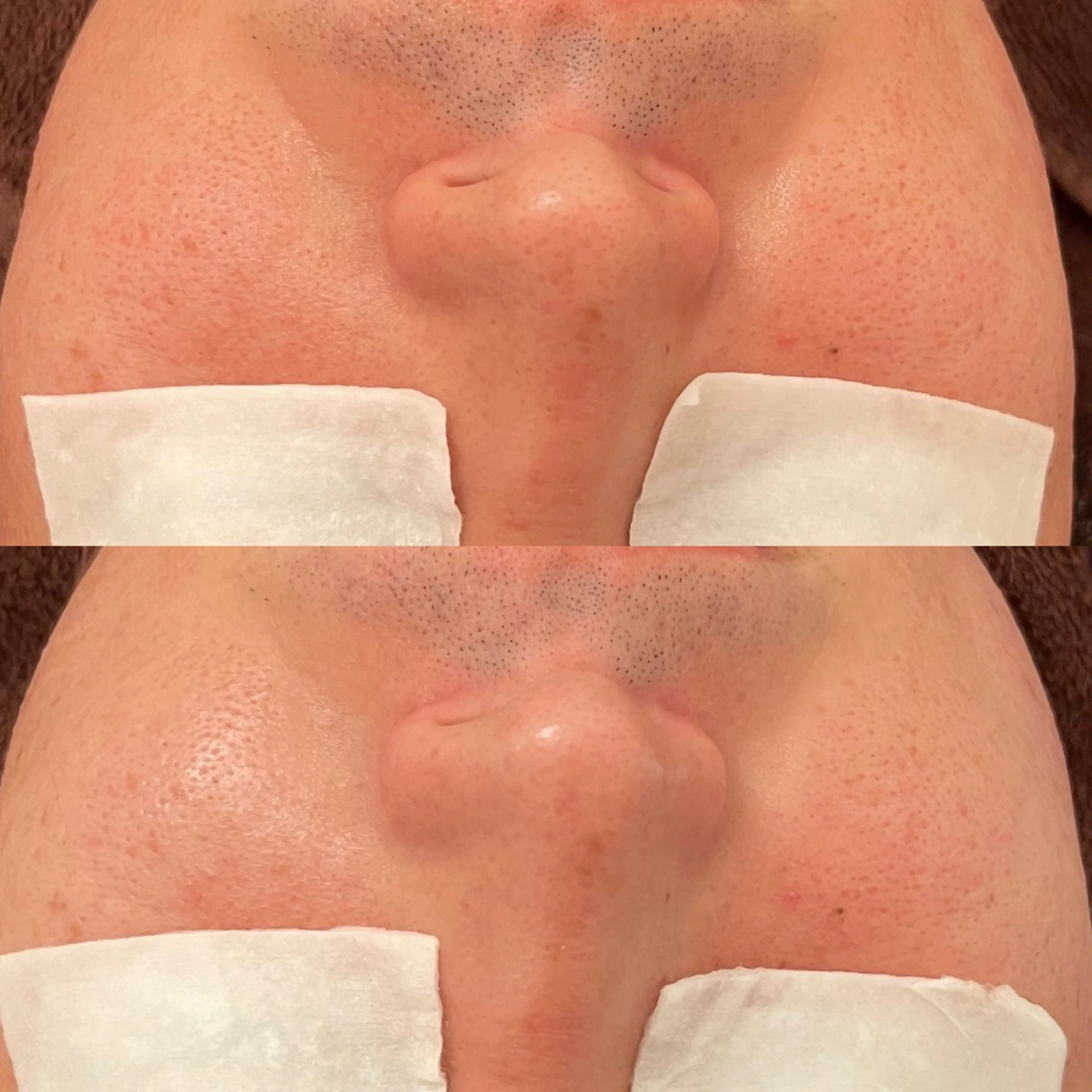 メンズ 毛穴ケア/毛穴診断/ 毛穴洗浄〔心斎橋〕のエステ・リラクイメージ