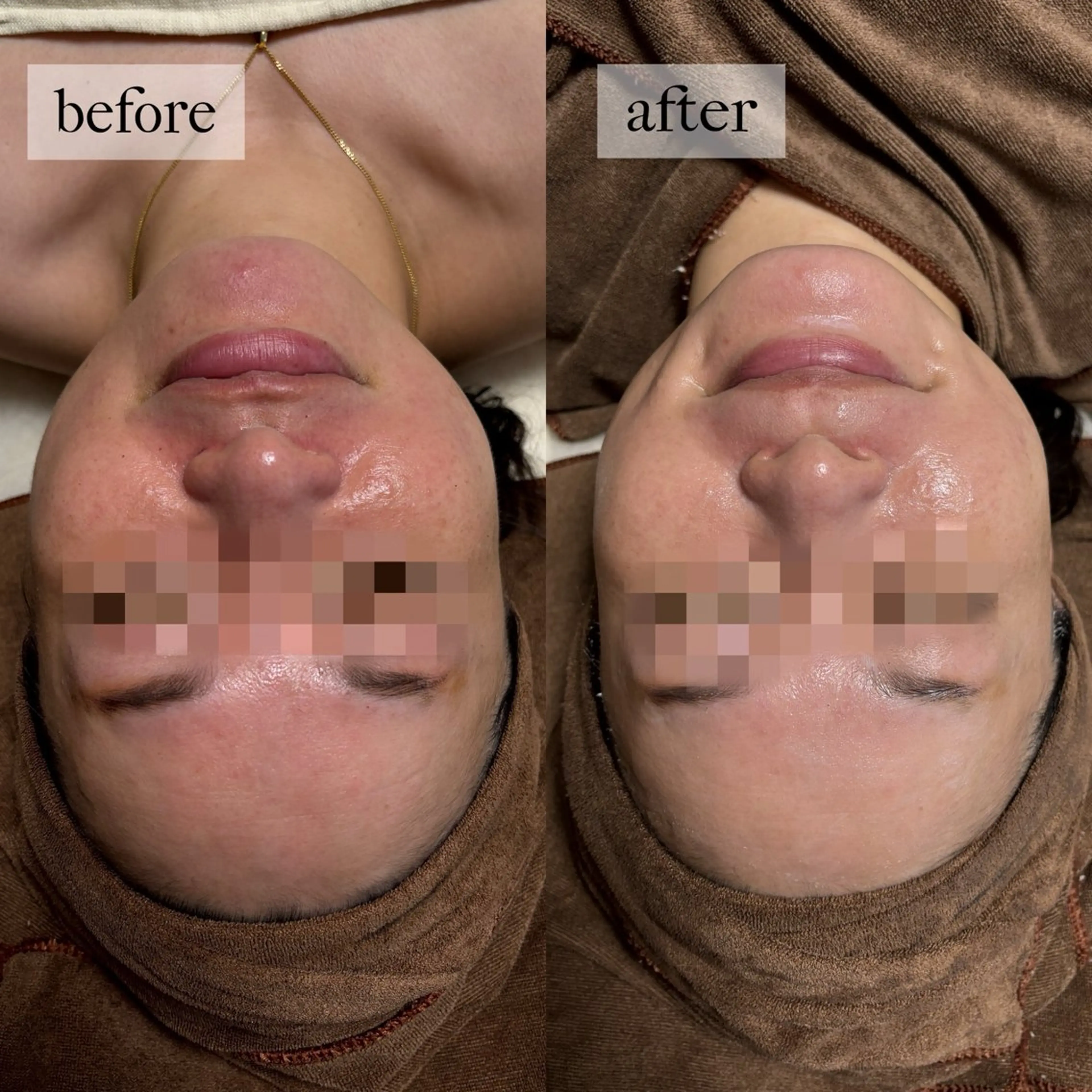 HINANO矢場町店【ヒナノ】所属・脱毛/肌改善🌿 HINANO 村田のエステ・リラクイメージ