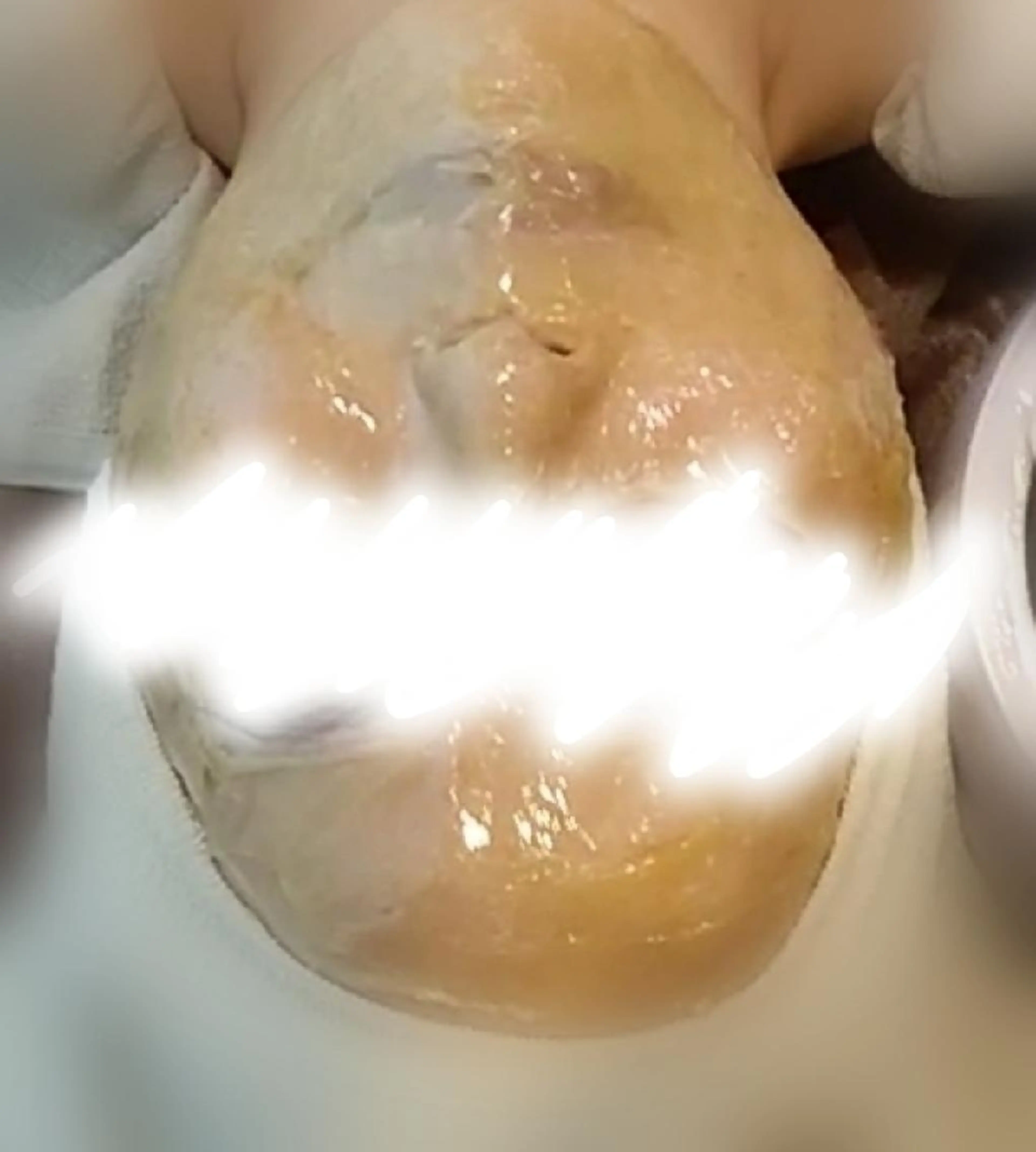 【お手軽毛穴ケア・脱毛】マツヤニホットセラピーの写真