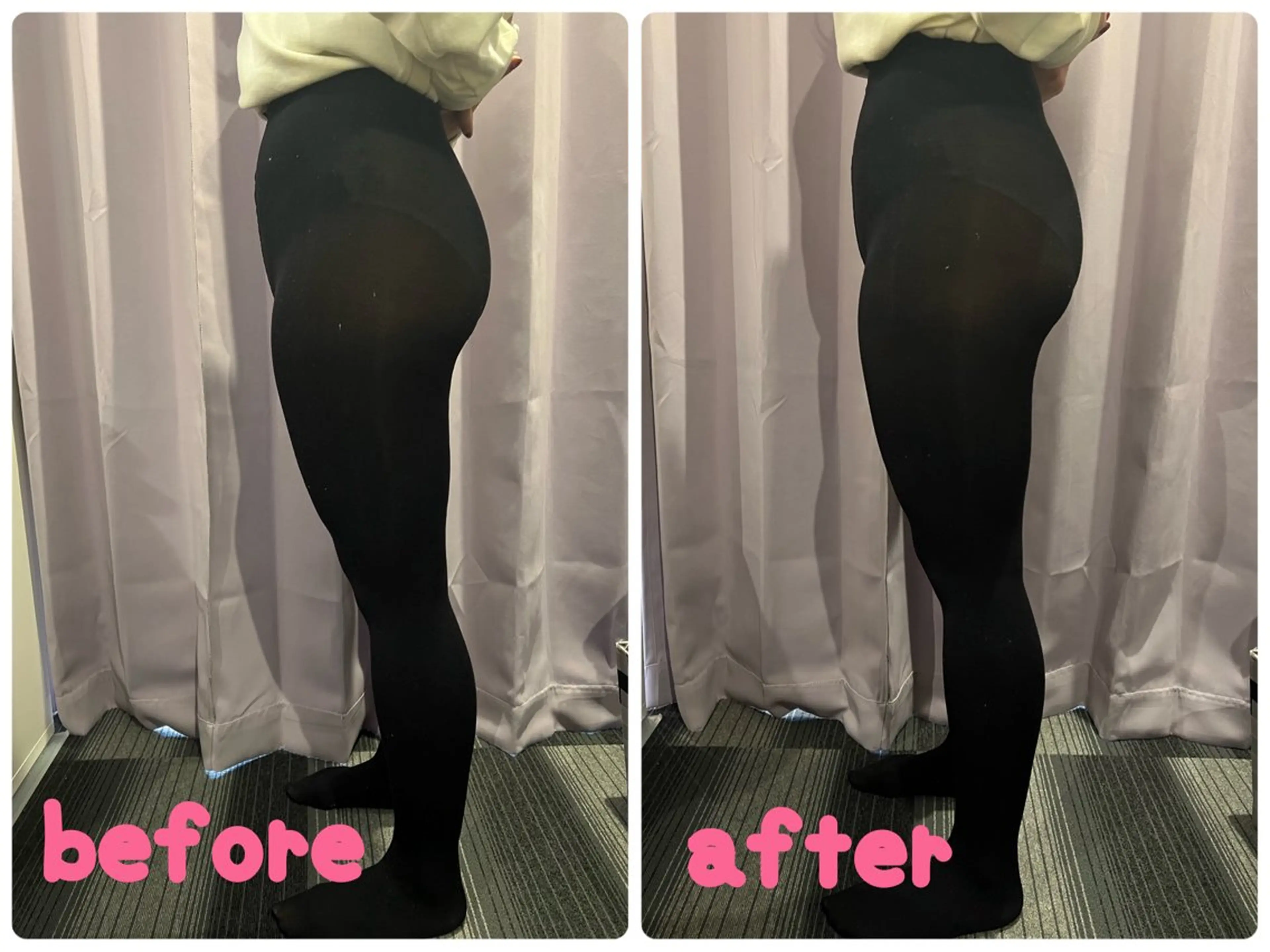 美脚矯正の写真