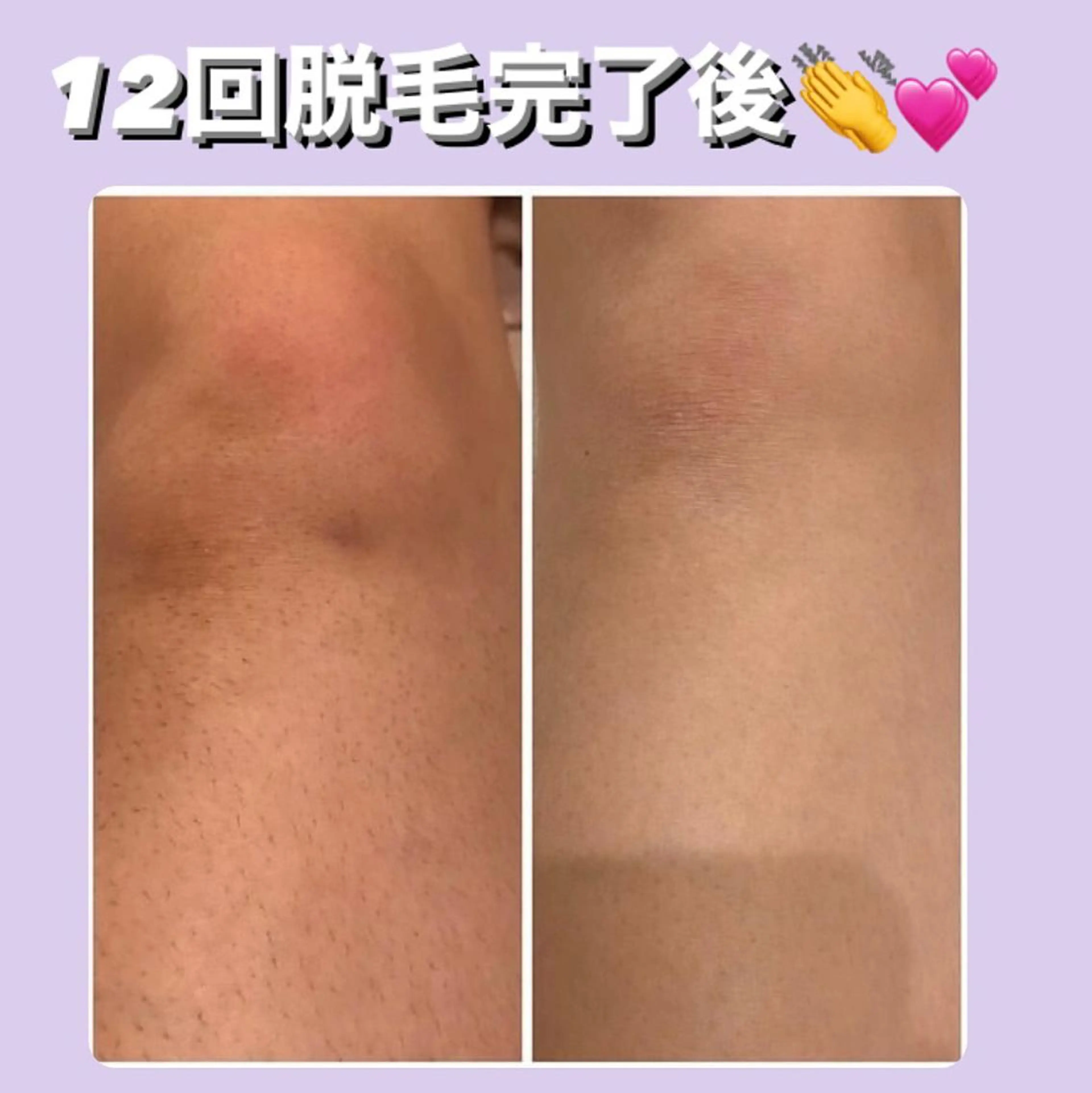 脱毛 ULULU上野店所属・ULULU 上野店のエステ・リラクイメージ