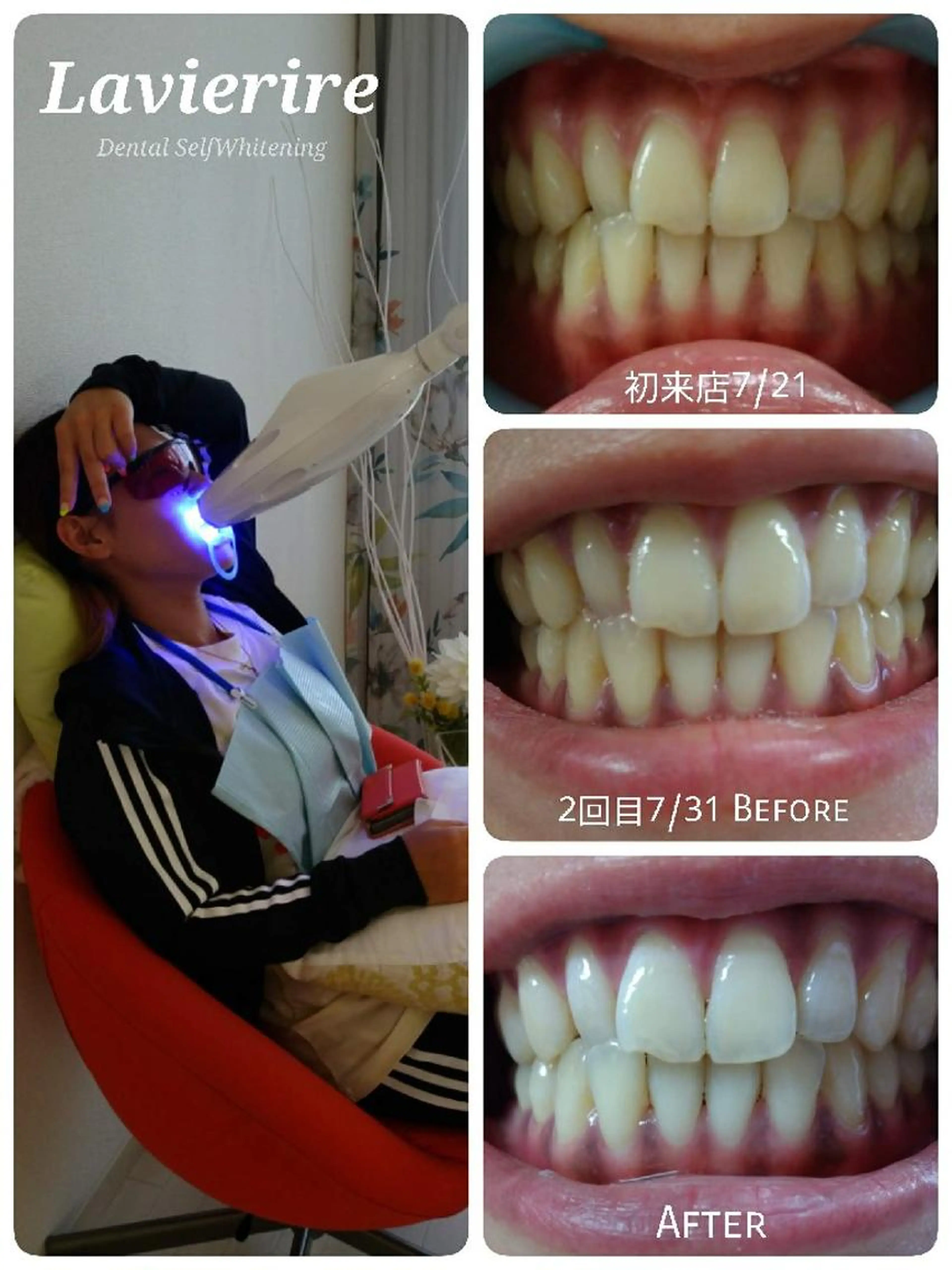 セルフホワイトニング5回コースの写真