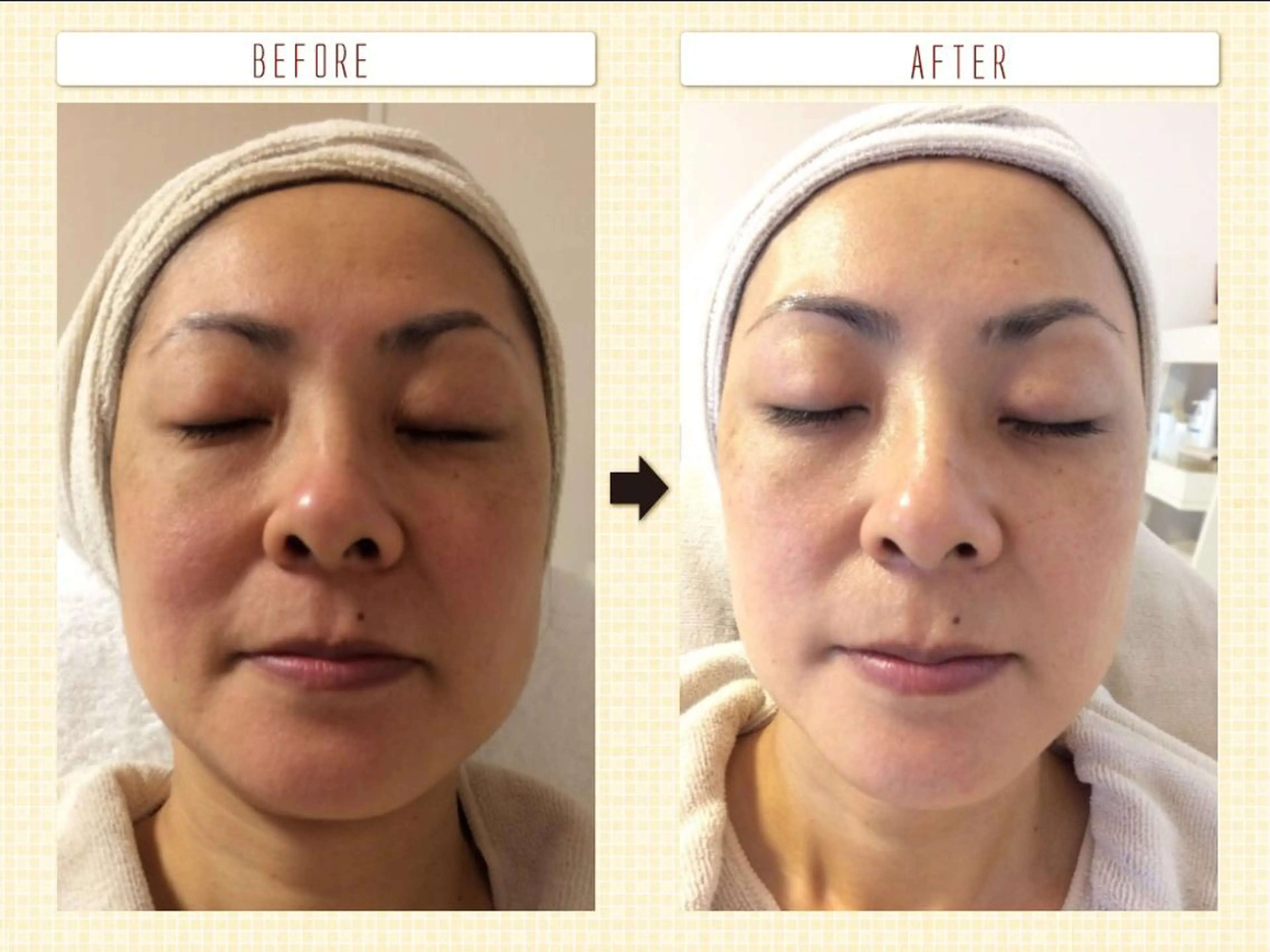 【顔脱毛(光フェイシャル)】（30分）の写真