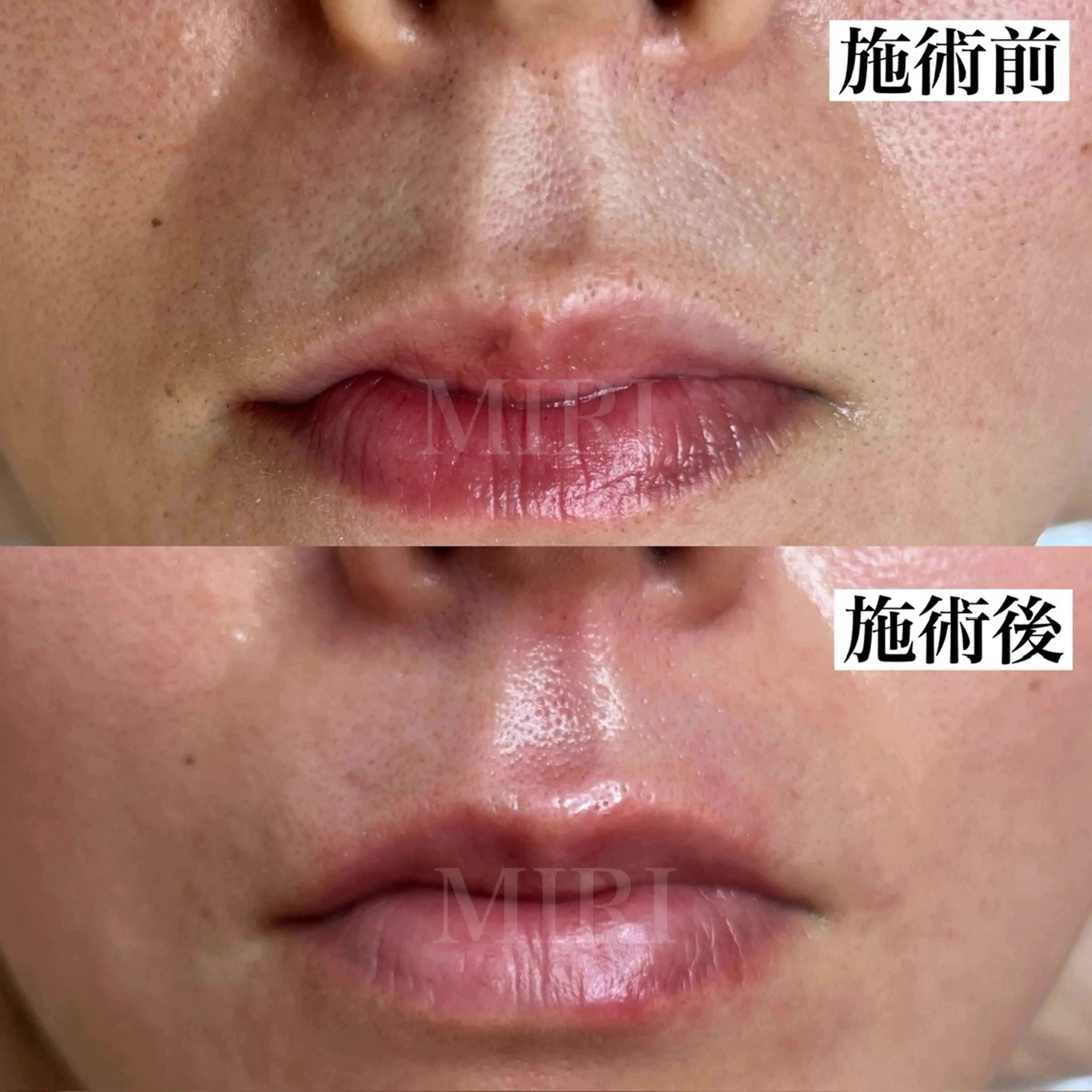 エステ MIRI所属・北堀江/毛穴改善専門 ミリのエステ・リラクイメージ