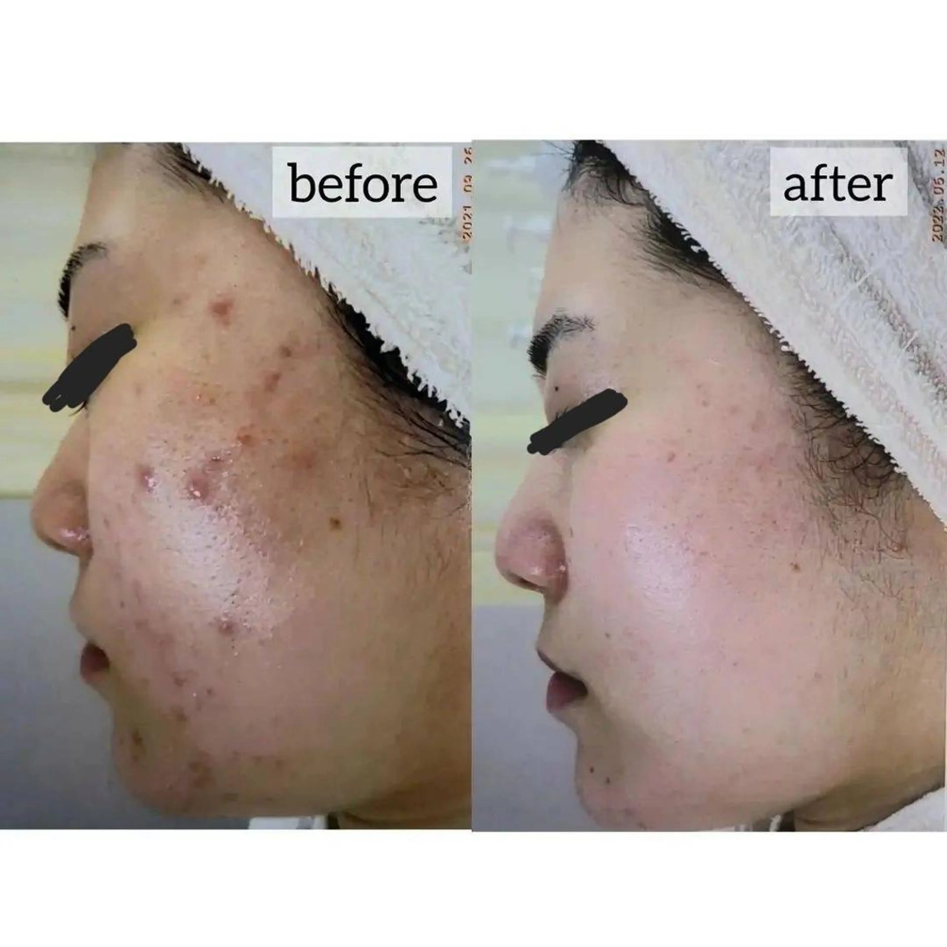 【ホームケア付き徹底肌質改善！！】ニキビケア4回コース＋1か月分の写真