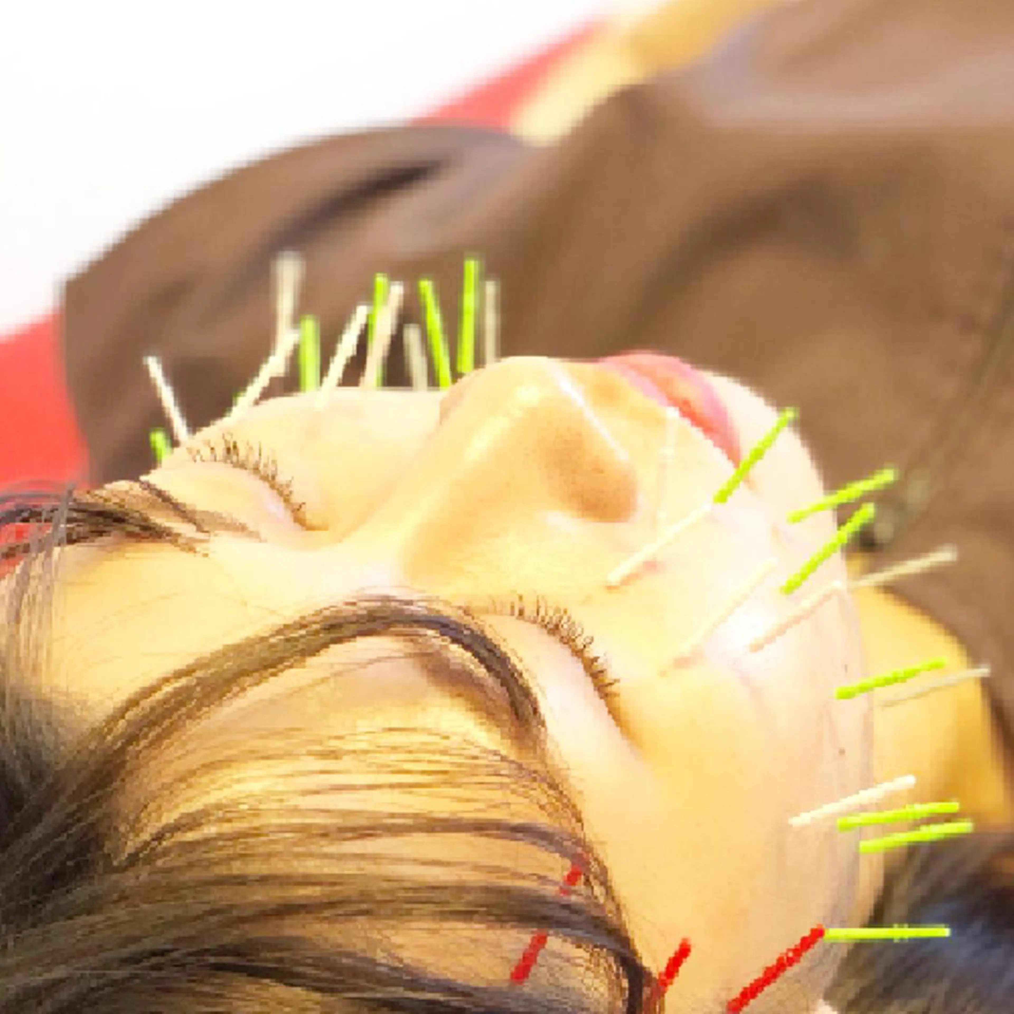 🌈リフトUP美容鍼 🙌 オオシマ🌈のエステ・リラクイメージ